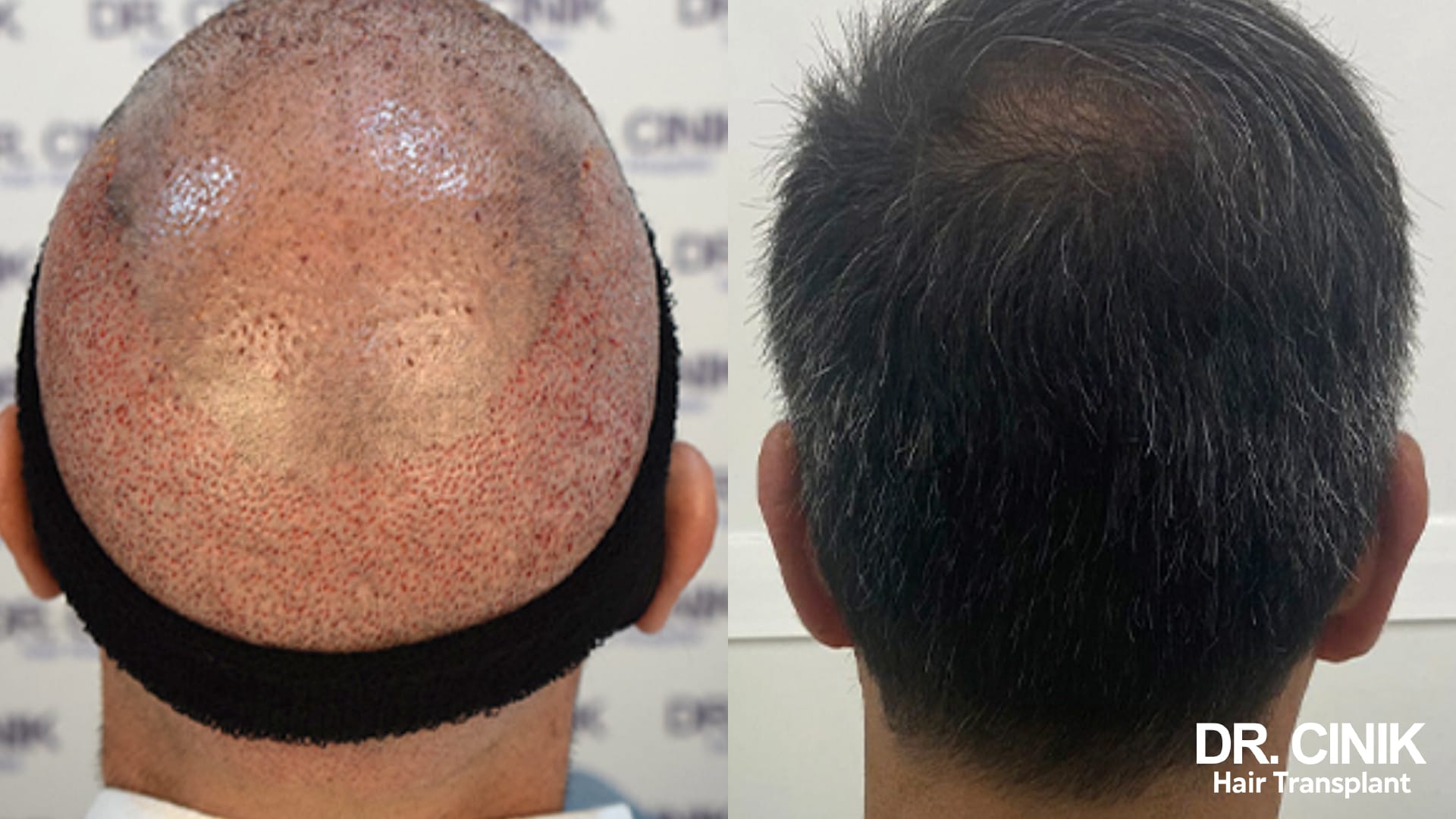 The same nape compared, covered in red extraction dots just after surgery on the left, fully healed under dense hair on the right
