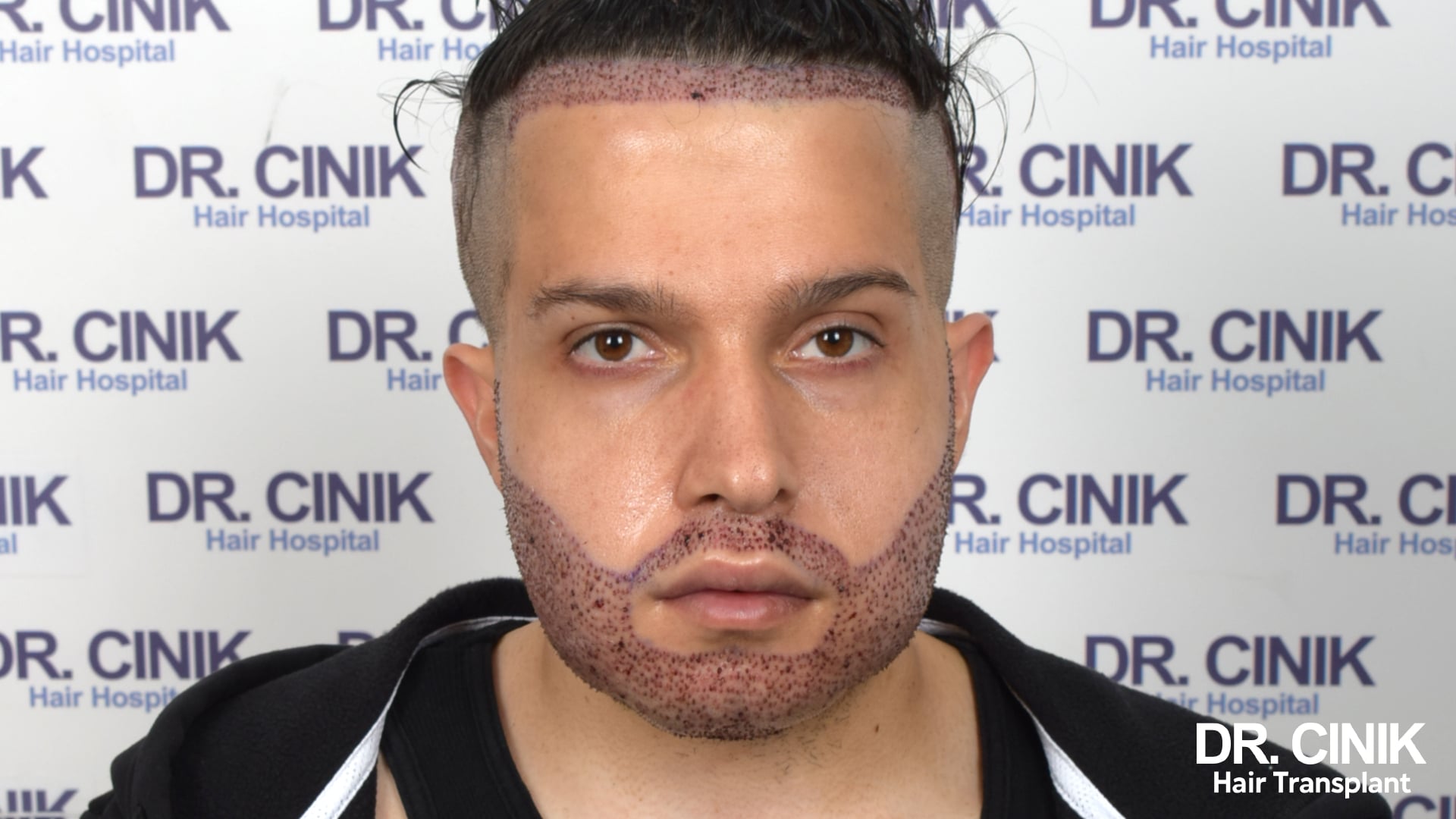 Patient photographié juste après l'intervention, greffons implantés visibles en pointillés rouges sur les joues, le menton et la ligne frontale