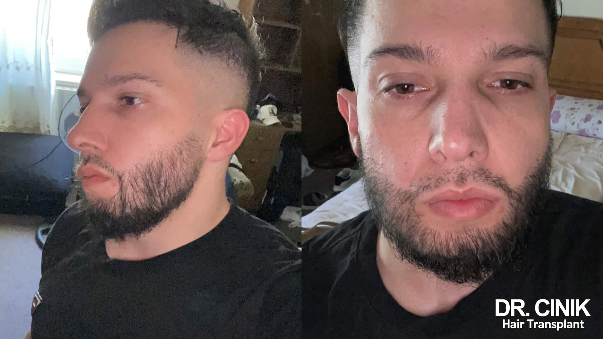 Deux photos personnelles du même patient, la barbe visiblement plus dense sur les joues et la mâchoire