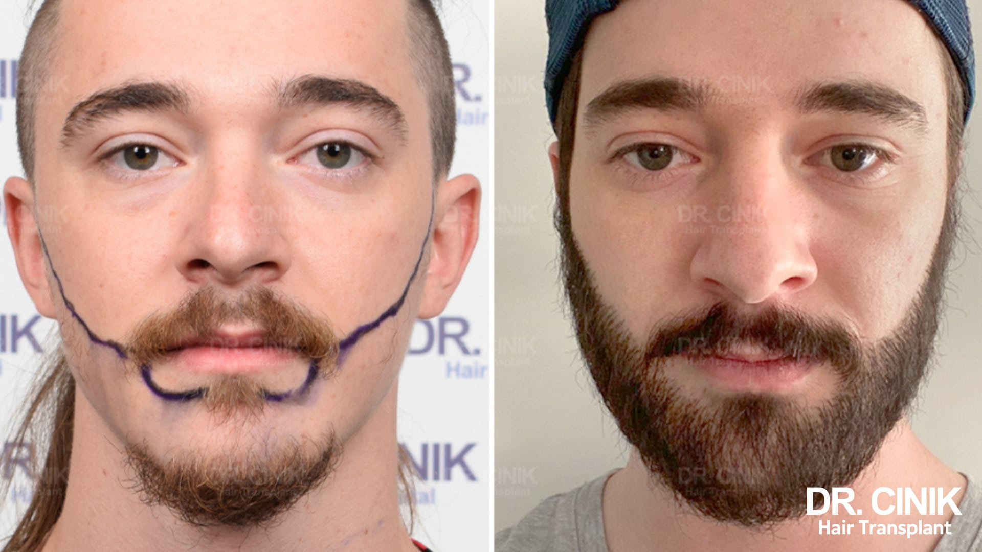 Avant après de face : tracé préopératoire sur une barbe éparse à gauche, barbe dense et fournie à droite
