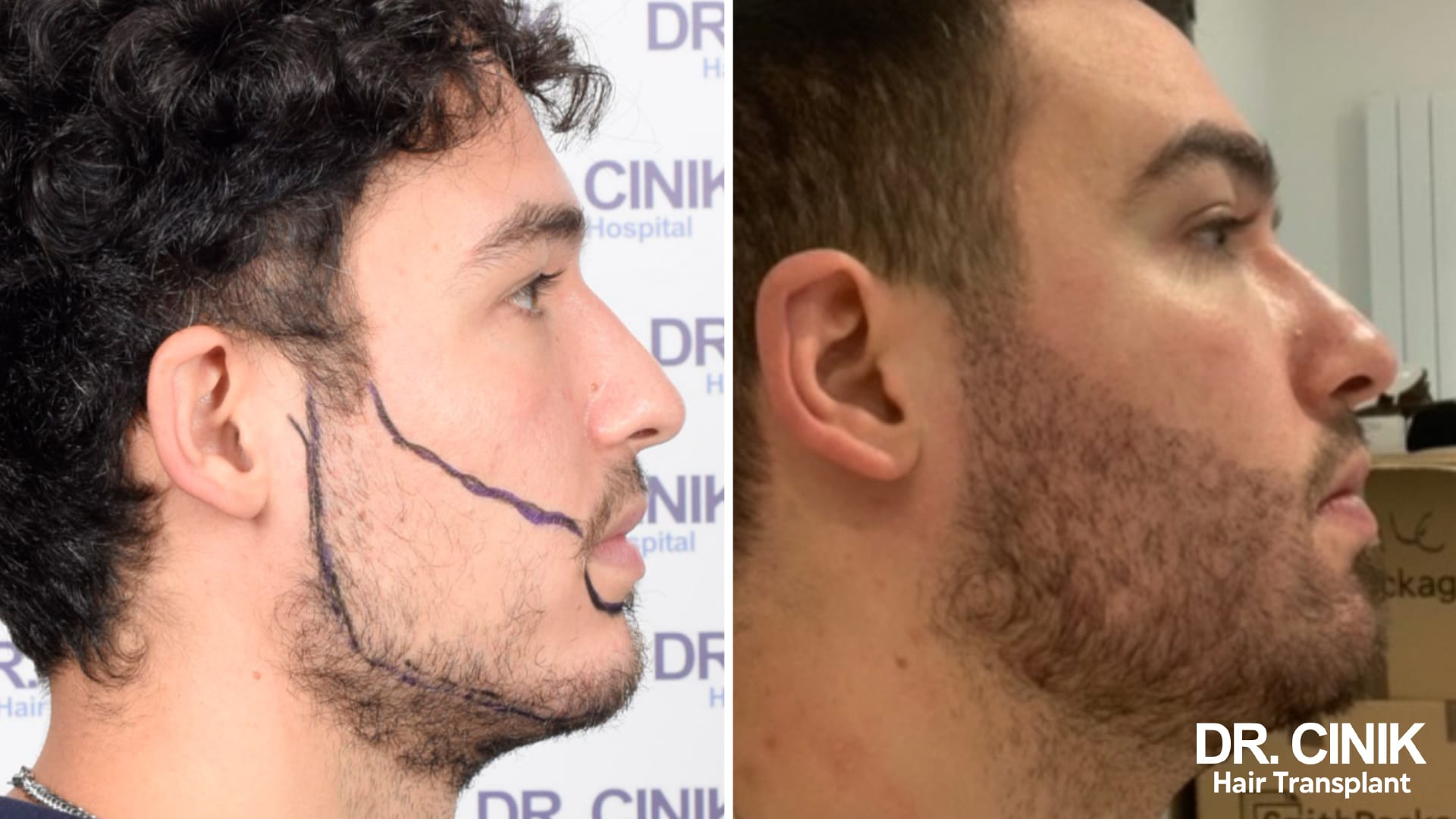 Avant après de profil : à gauche une joue clairsemée avec tracé préopératoire, à droite une barbe dense couvrant la joue et la mâchoire