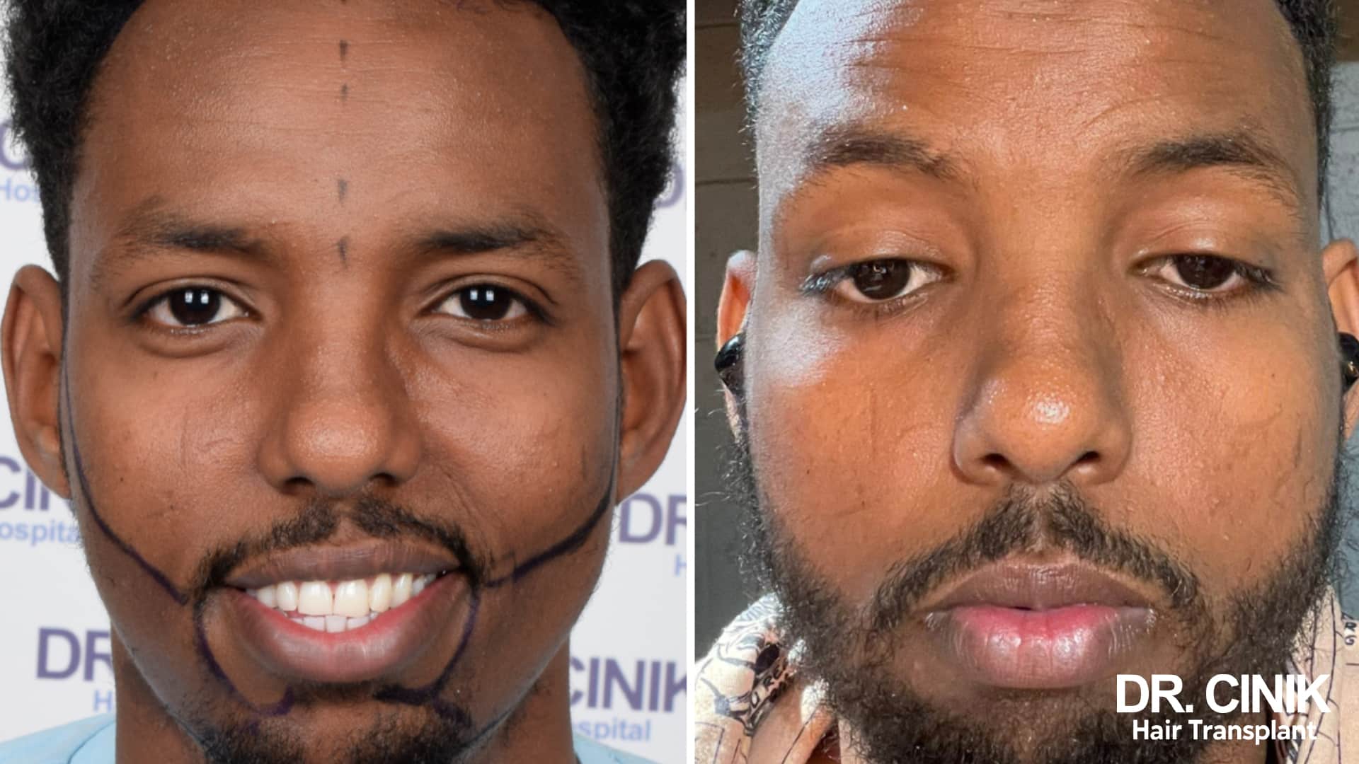 Avant après d'une greffe de barbe chez un patient à la peau foncée, tracé visible à gauche et barbe étoffée à droite