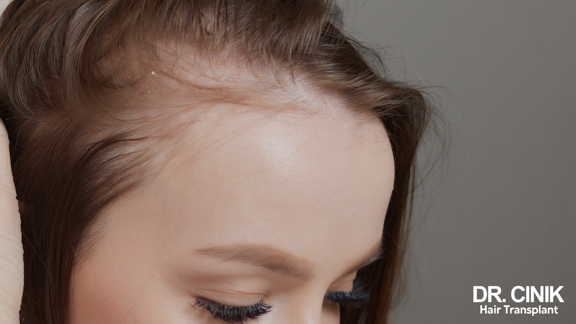 Close-up of a woman's forehead where the hairline has receded, leaving a band of bare skin above the remaining hair