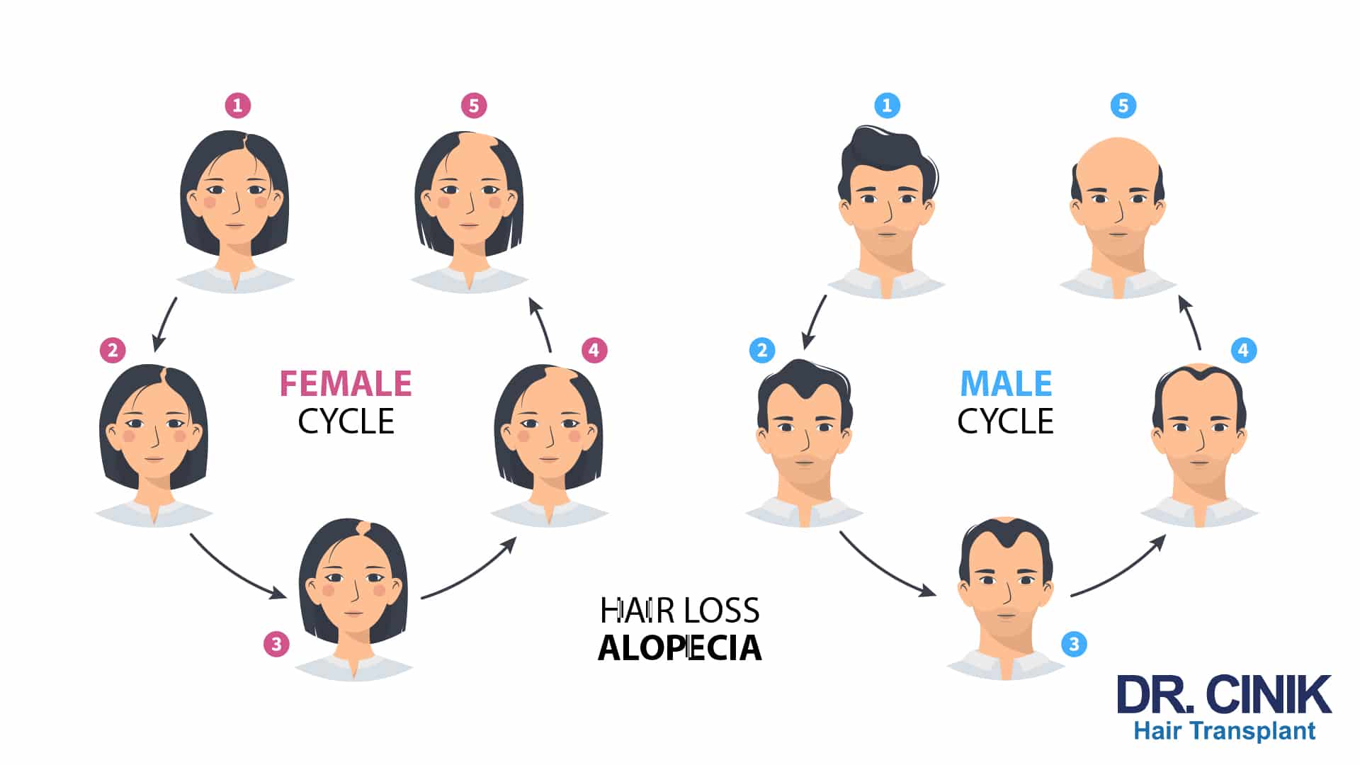 Infographic with two circles showing hair loss in five stages, the female cycle with a widening parting and the male cycle with a receding hairline leading to baldness, labelled hair loss alopecia