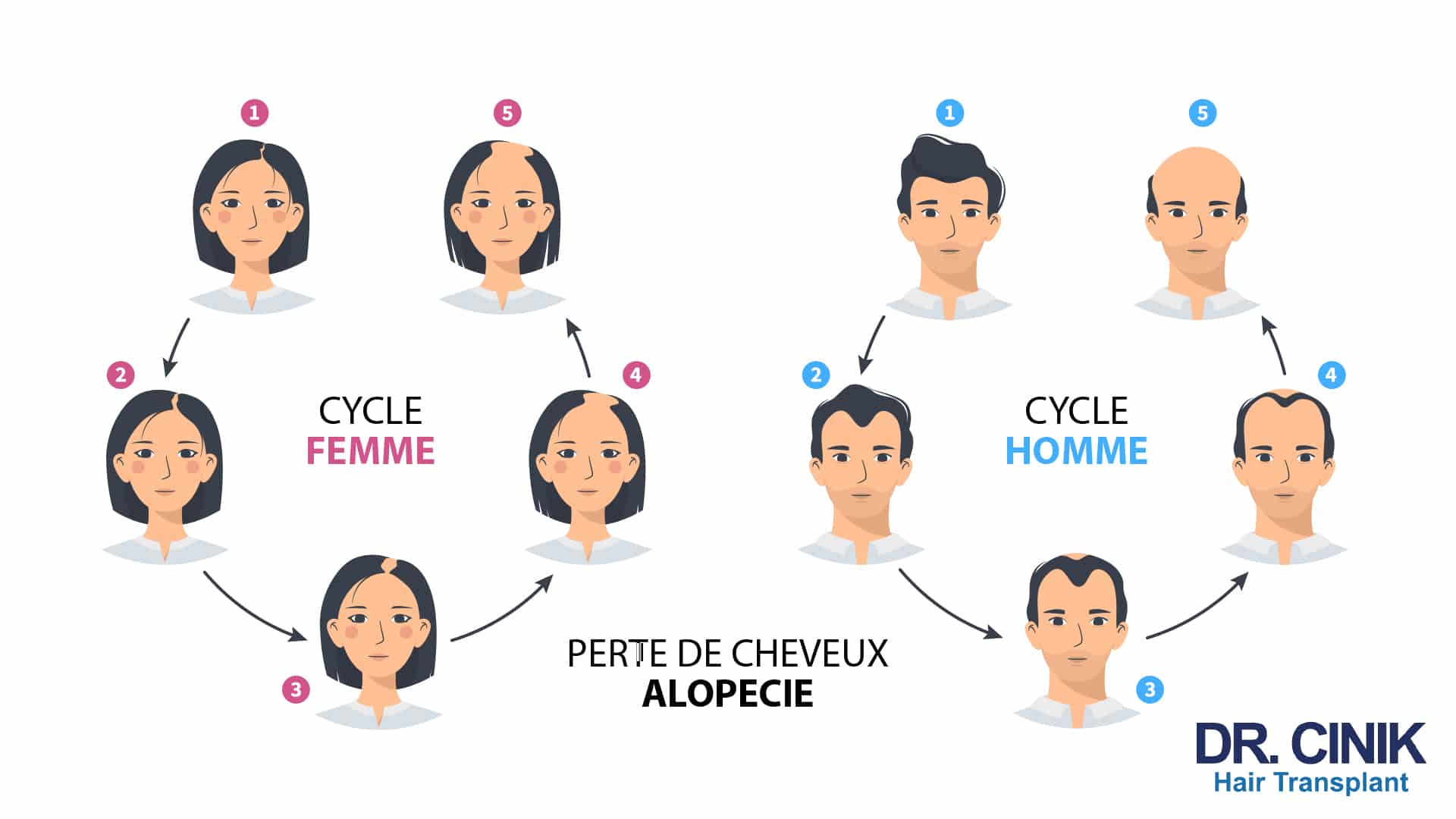 Infographie en deux cercles montrant la progression de l'alopécie en cinq étapes, chez la femme avec une raie qui s'élargit et chez l'homme avec un recul des golfes jusqu'à la calvitie