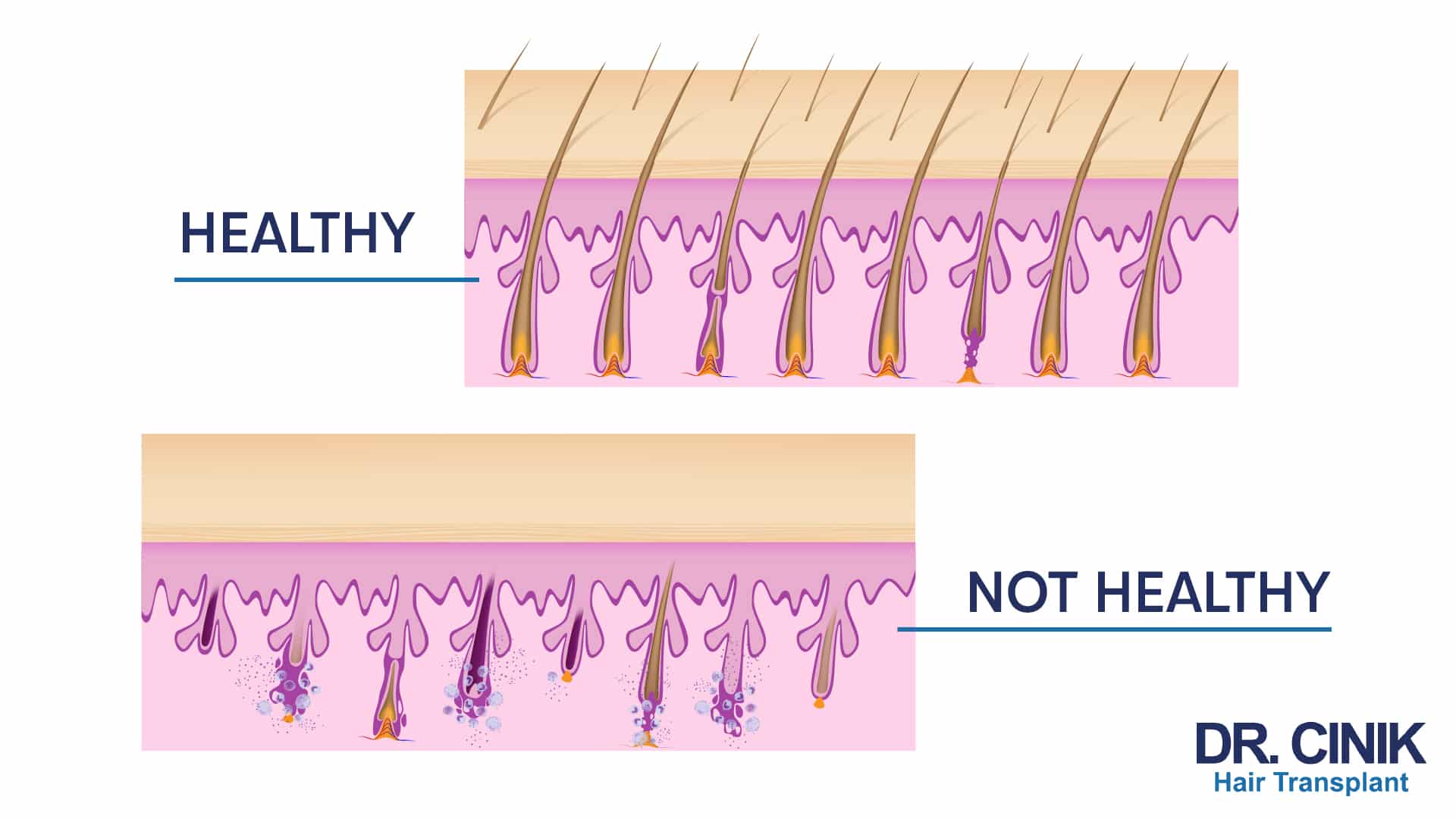 Two-panel comparison of hair follicles seen in cross-section, the upper one labelled Healthy with thick, well-anchored shafts, the lower one labelled Not healthy with degraded follicles and sparse hair