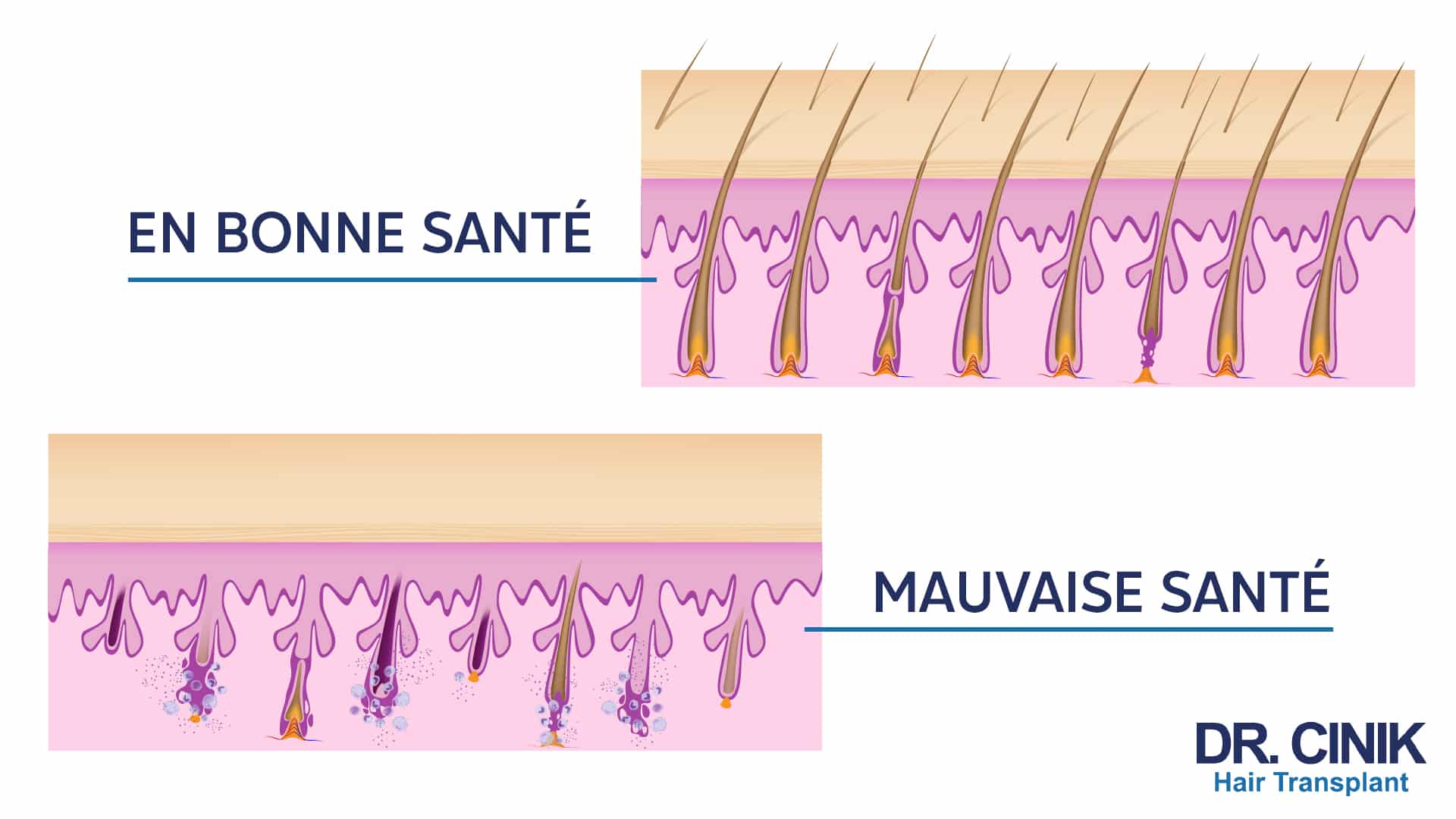 Comparaison en deux planches de follicules pileux vus en coupe, l'une étiquetée « en bonne santé » avec des tiges épaisses et bien implantées, l'autre « mauvaise santé » avec des follicules dégradés et des cheveux clairsemés