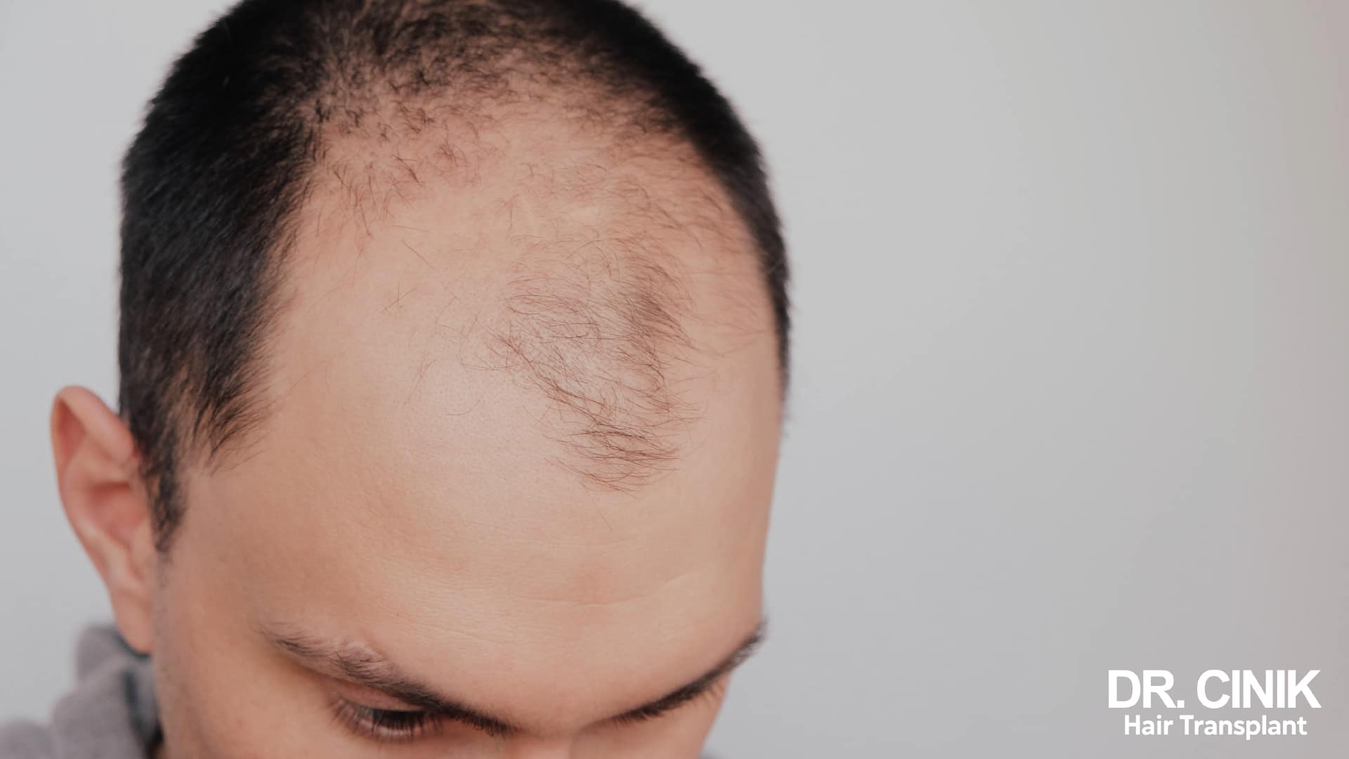 A man's forehead showing an irregular bare patch behind the hairline