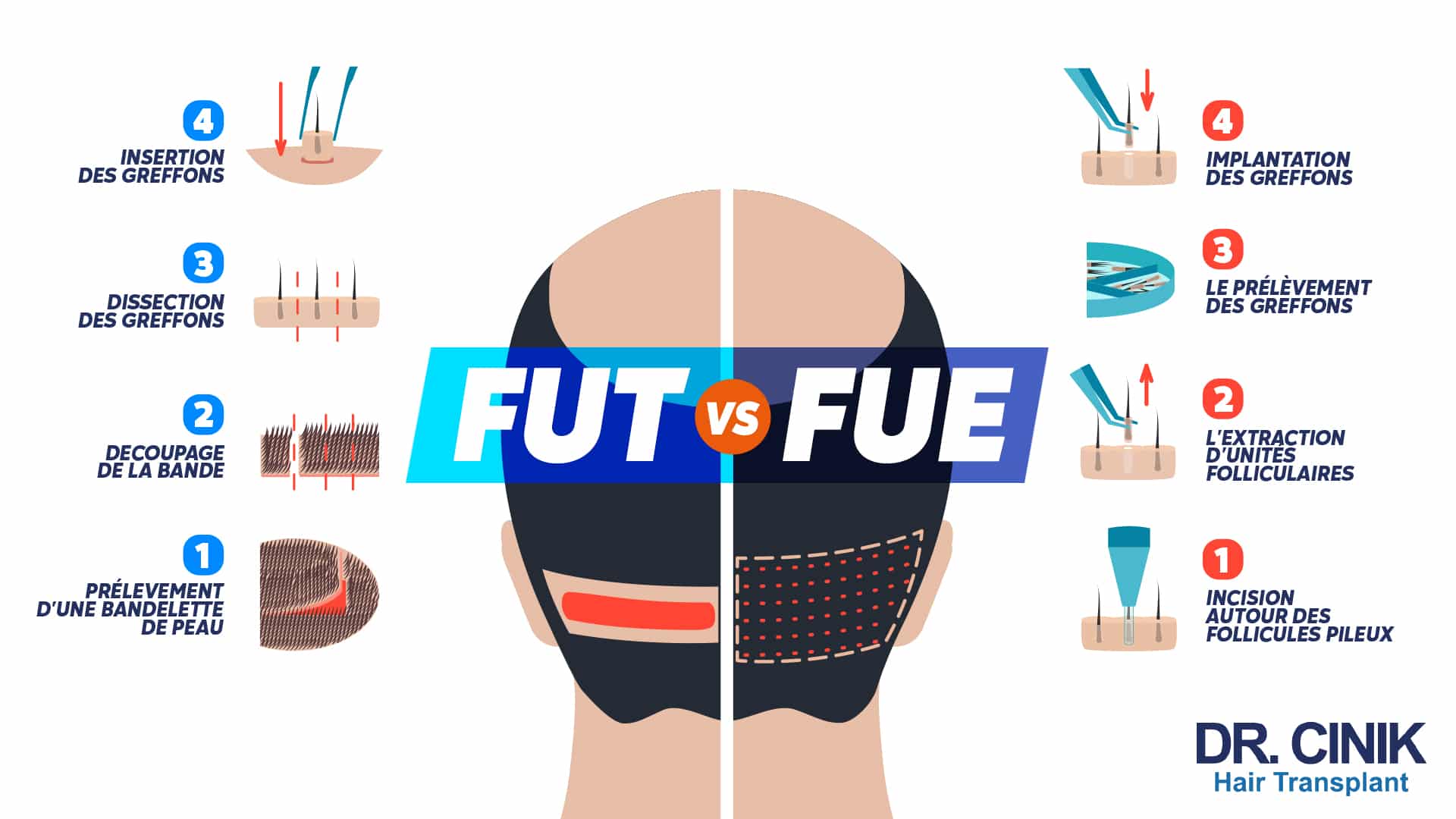 Infographie comparant en quatre étapes numérotées la technique FUT, avec prélèvement d'une bandelette de peau, découpage, dissection puis insertion des greffons, et la technique FUE, avec incision autour des follicules, extraction unitaire, prélèvement puis implantation