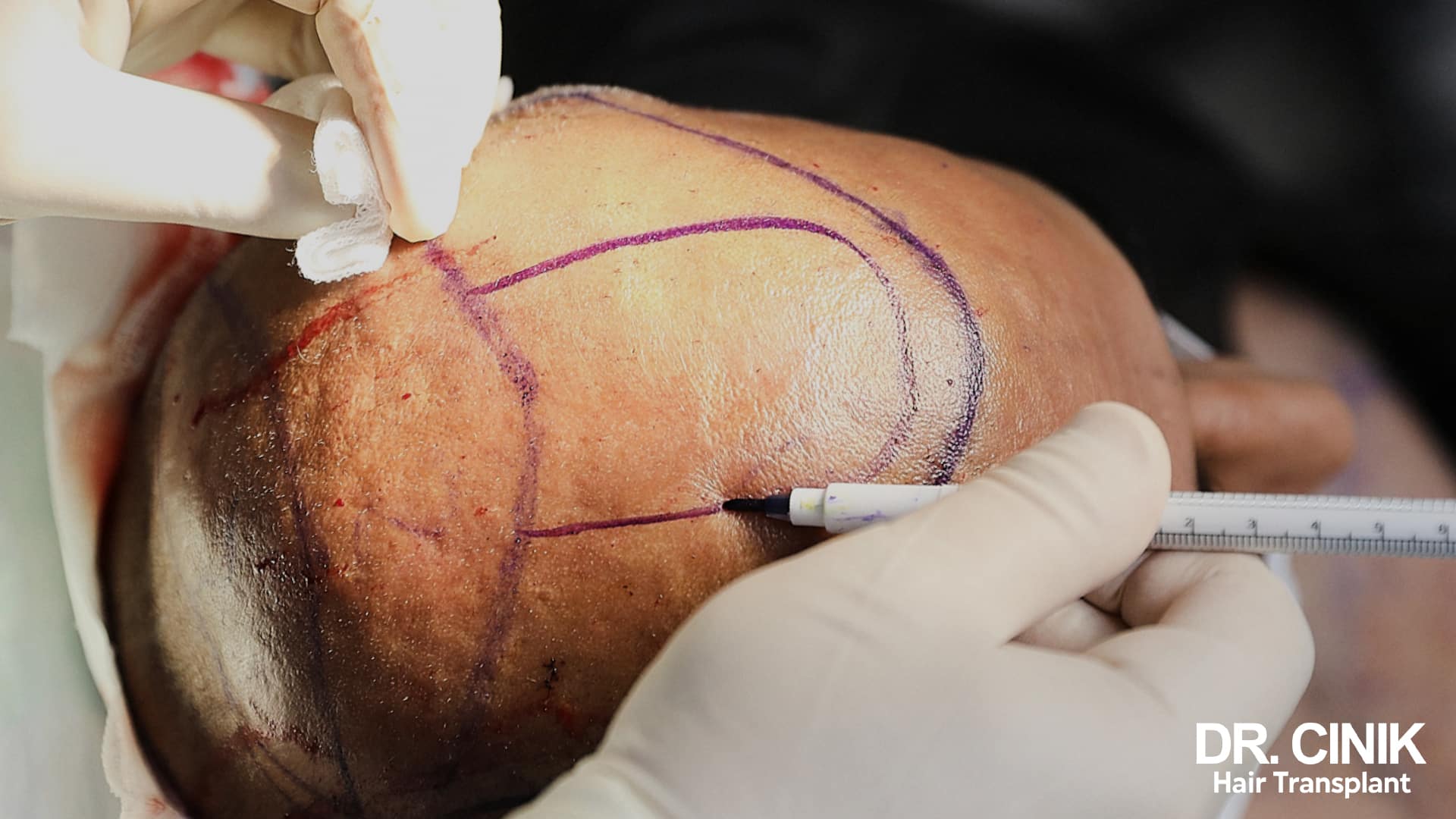 Praticien traçant à la règle et au feutre violet les limites de la zone donneuse à l'arrière du crâne rasé d'un patient