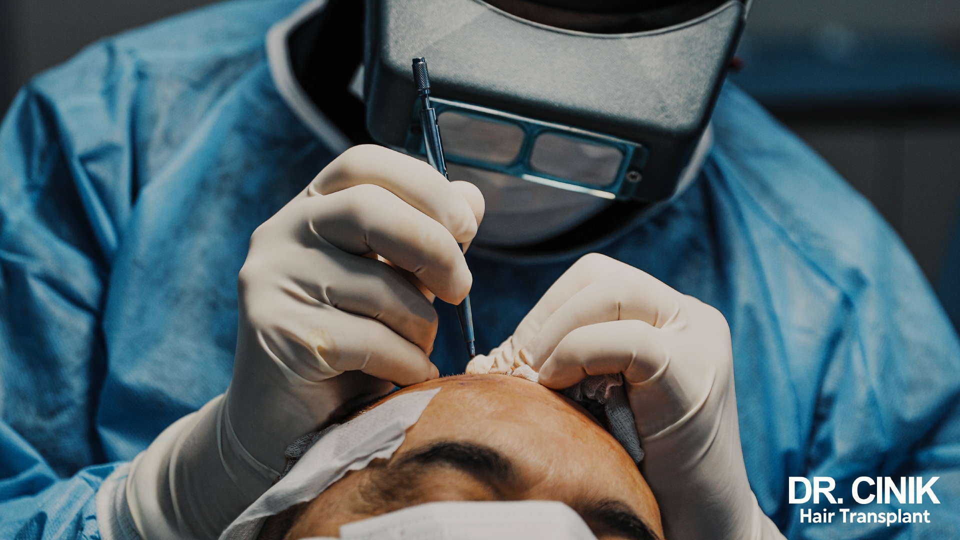 Praticien portant loupes binoculaires et masque réalisant une extraction follicule par follicule à l'aide d'un instrument fin sur le crâne rasé d'un patient