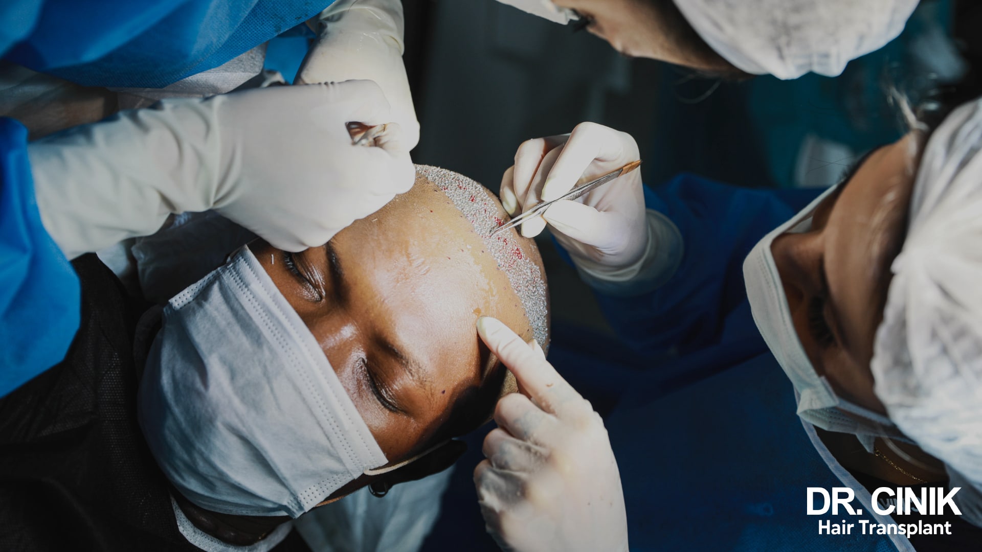 Grafts being implanted one by one with forceps along a patient's hairline in the operating theatre