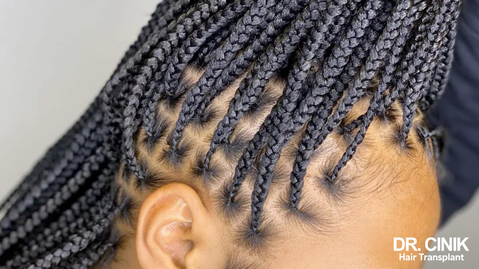 Profile view of a scalp with fine, tightly pulled braids, the hairline visibly stripped back around the ear