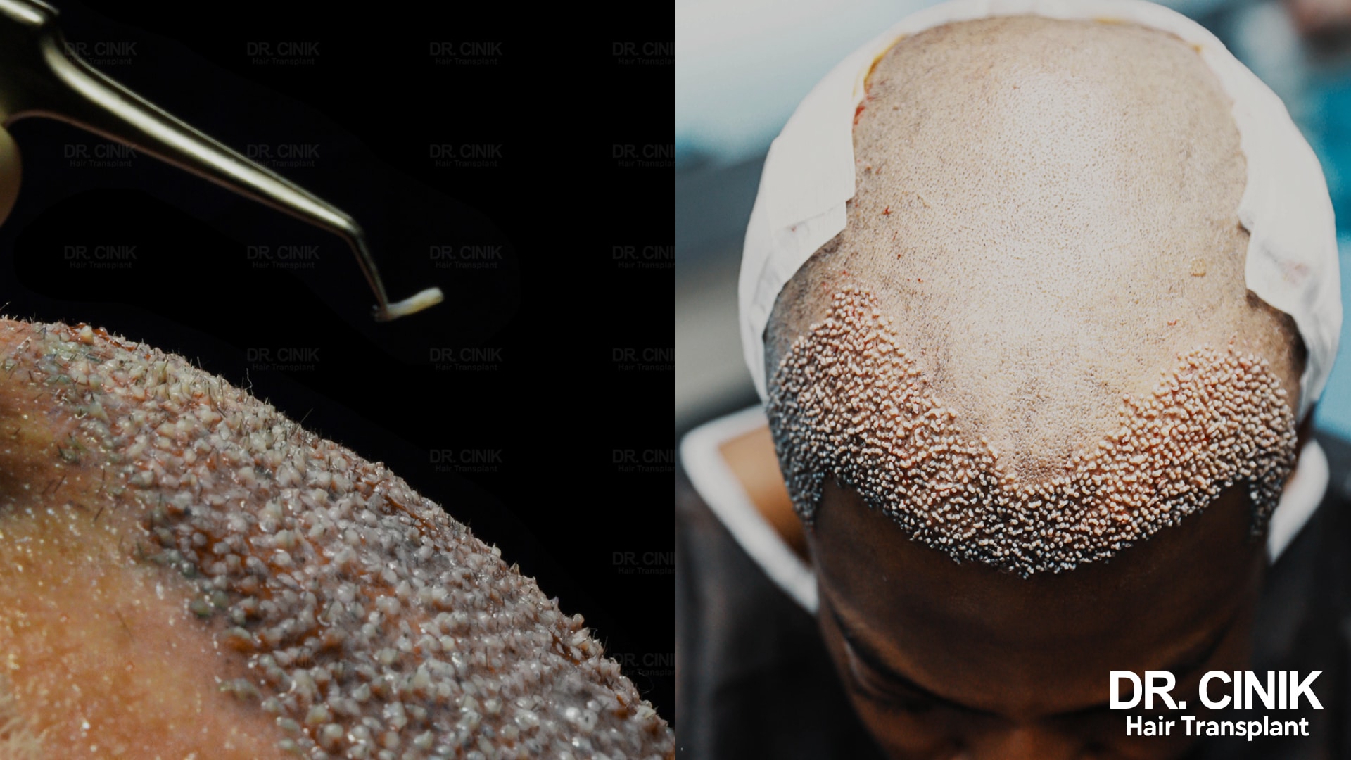 Close view of grafts implanted across the front of the scalp, immediately after the procedure