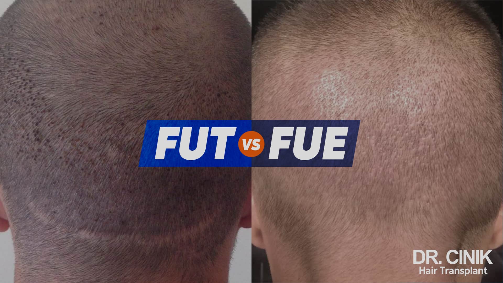 Image comparative de l'arrière du crâne de deux hommes, à gauche la fine cicatrice linéaire laissée par la FUT, à droite les multiples petits points de prélèvement laissés par la FUE