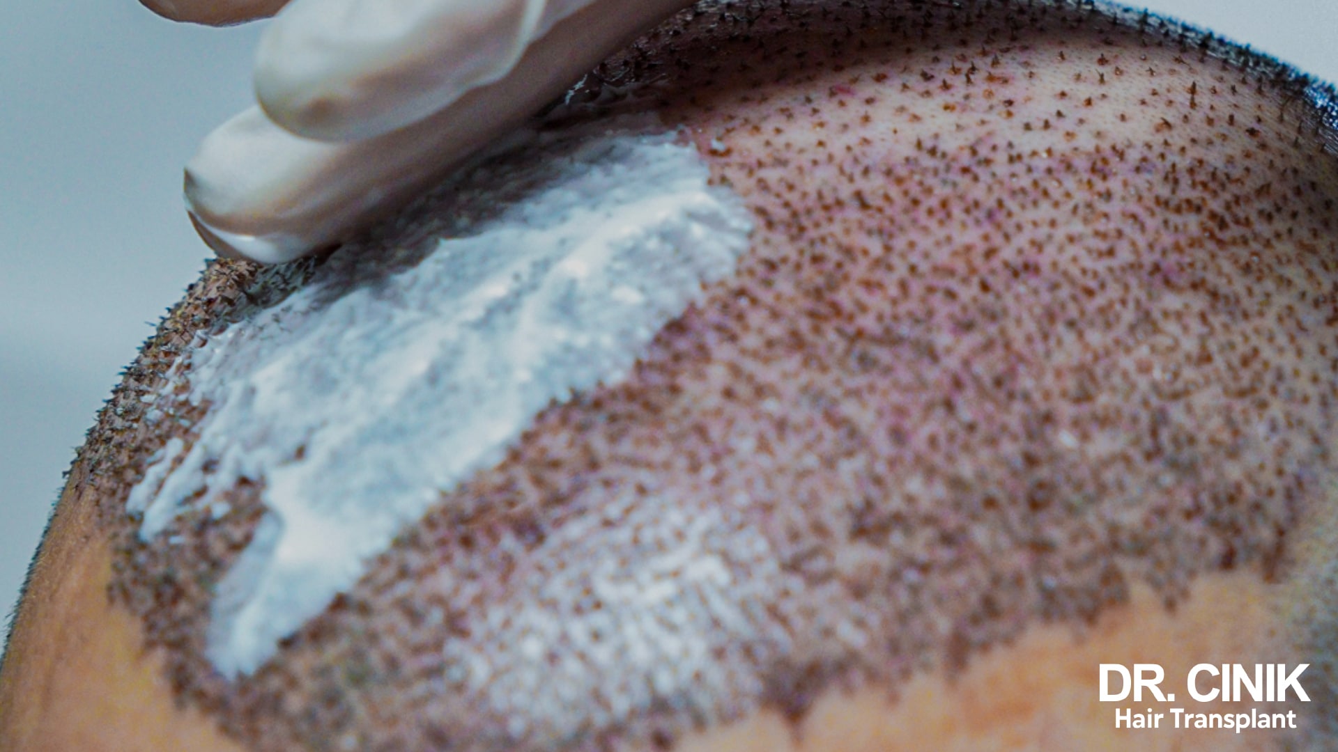 Main gantée appliquant une crème blanche épaisse sur une portion de cuir chevelu tondu où les greffons implantés sont entourés de petites croûtes
