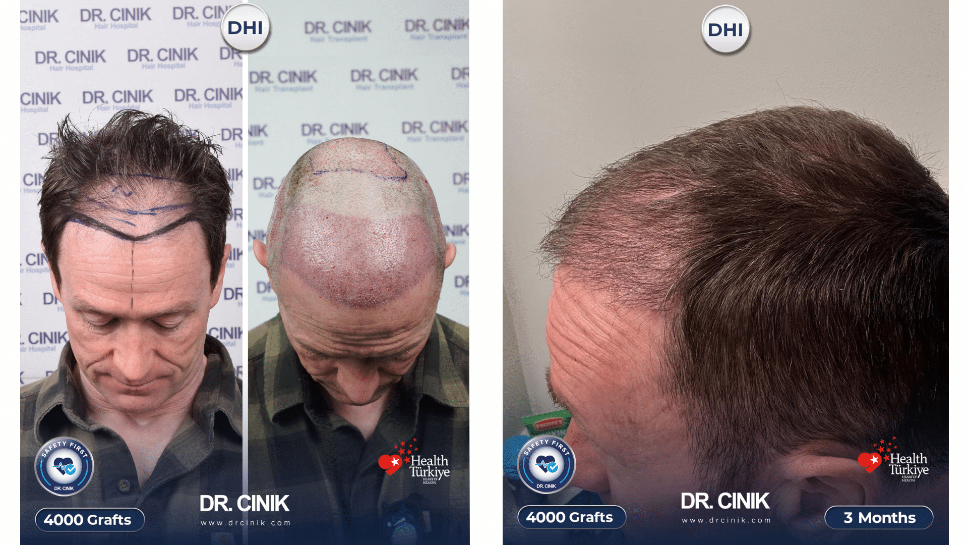 Greffe de cheveux de Gerry, avant et jour 1 à côté de la repousse à 3 mois, 4000 greffons