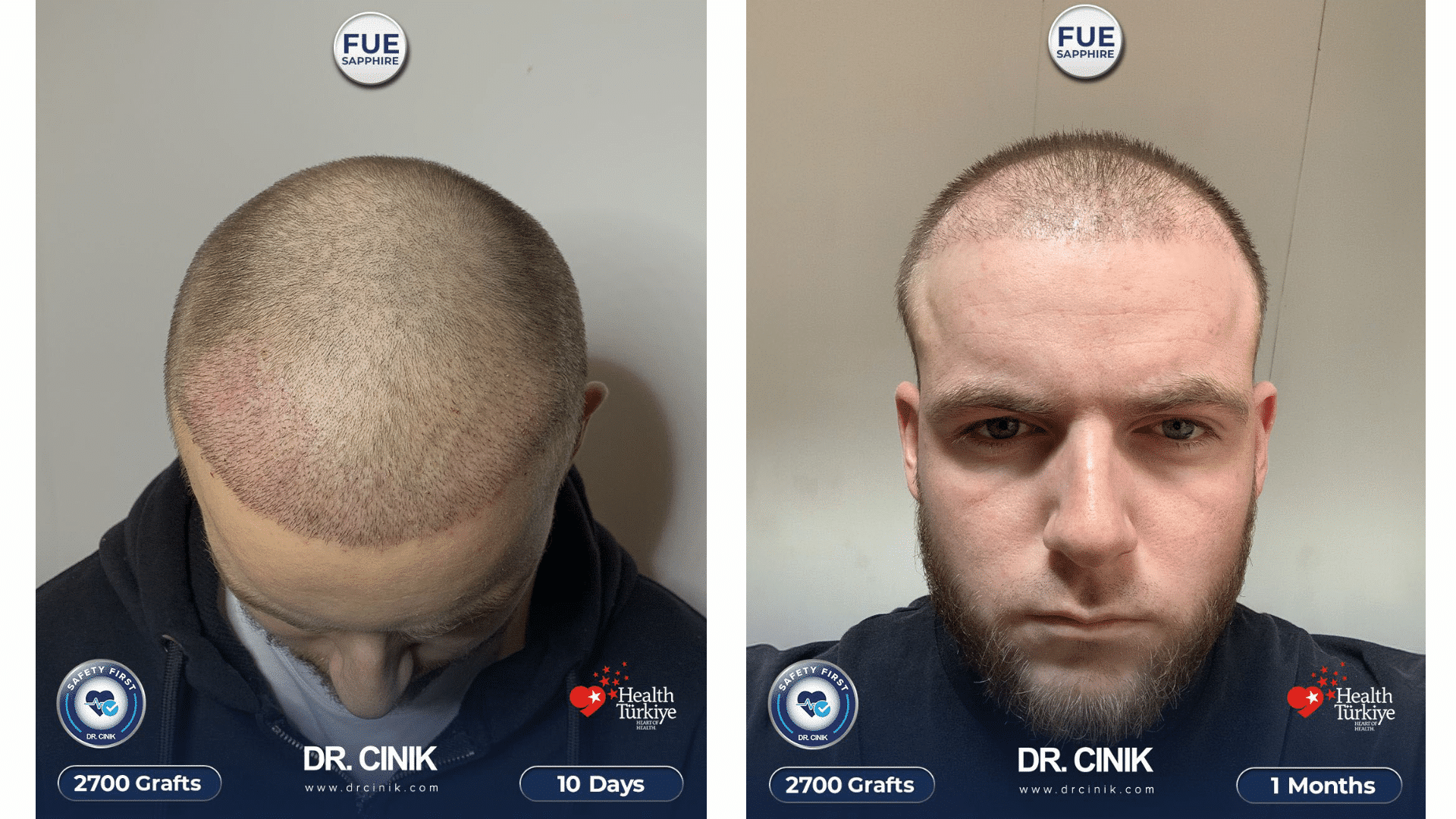 Greffe de cheveux de Larsee à 10 jours et 1 mois, saphir FUE, 2700 greffons