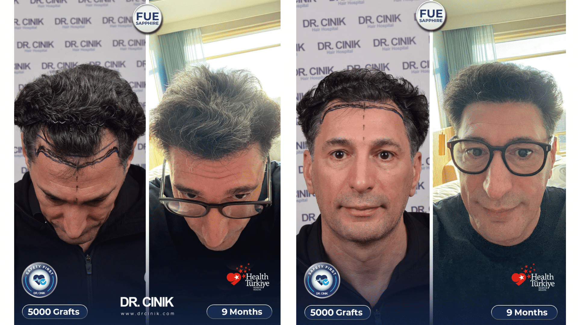 Greffe de cheveux de Moncef, avant après à 9 mois, 5000 greffons, résultat saphir FUE en Turquie
