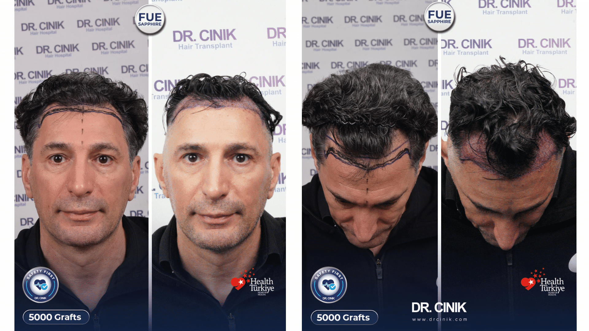 Greffe de cheveux de Moncef au jour 1, 5000 greffons, saphir FUE juste après l'intervention en Turquie