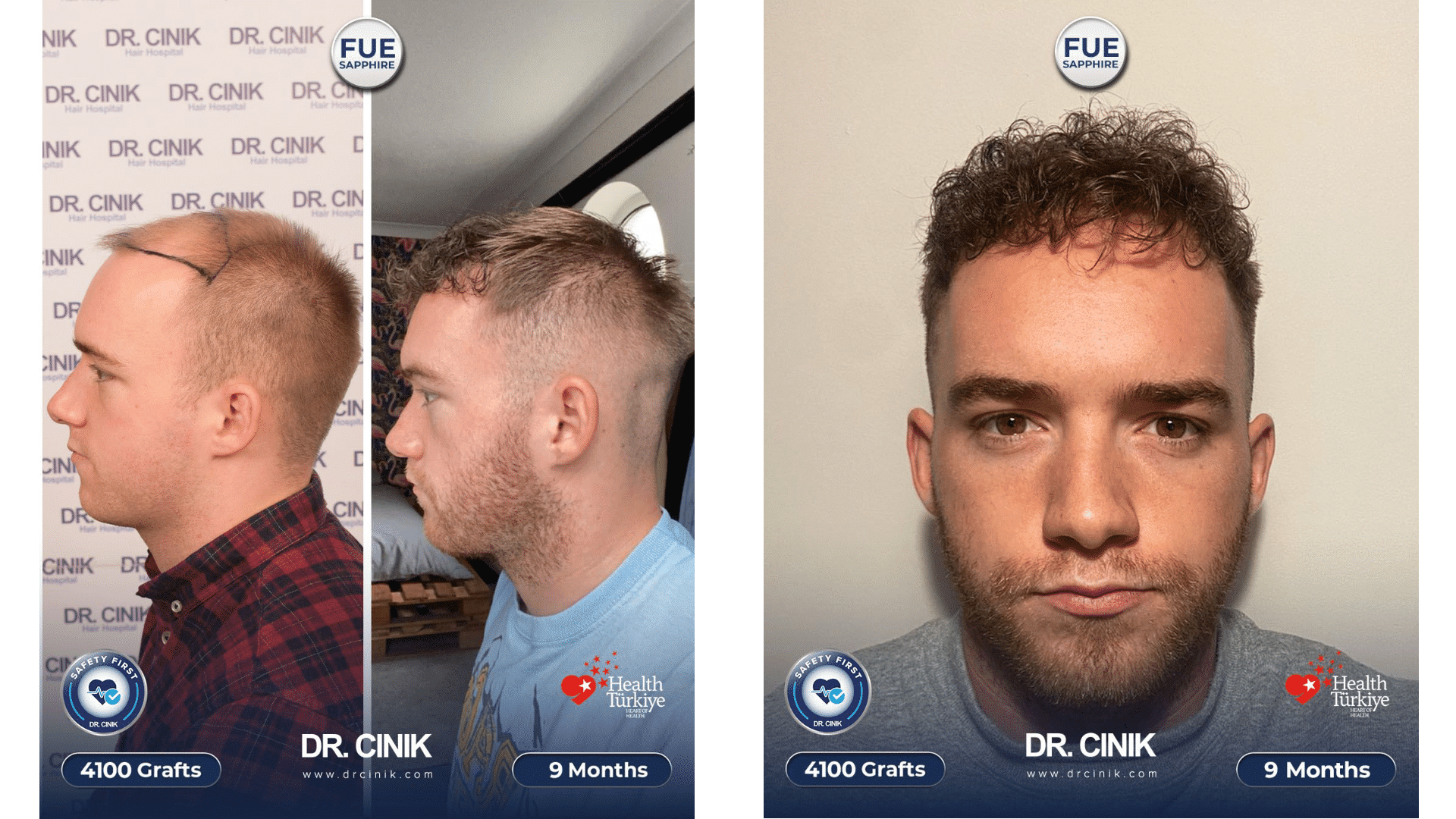 Résultat de la greffe de cheveux de Claron à 9 mois, 4100 greffons Sapphire FUE, avant après