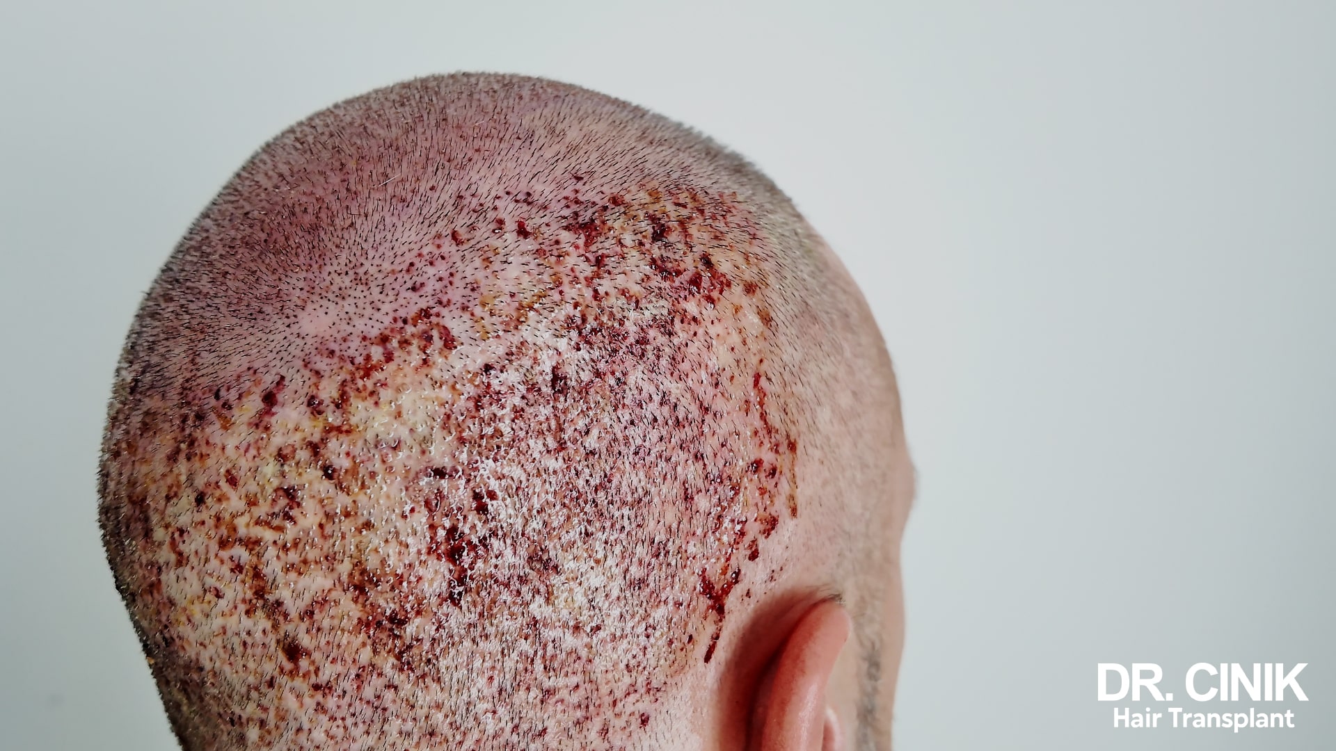 Necrosis and scalp complications