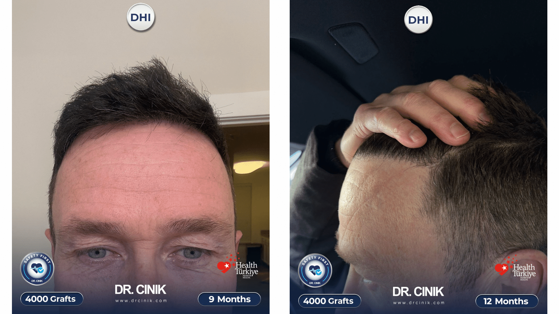 Greffe de cheveux de Gerry, évolution à 9 mois et à 12 mois, 4000 greffons