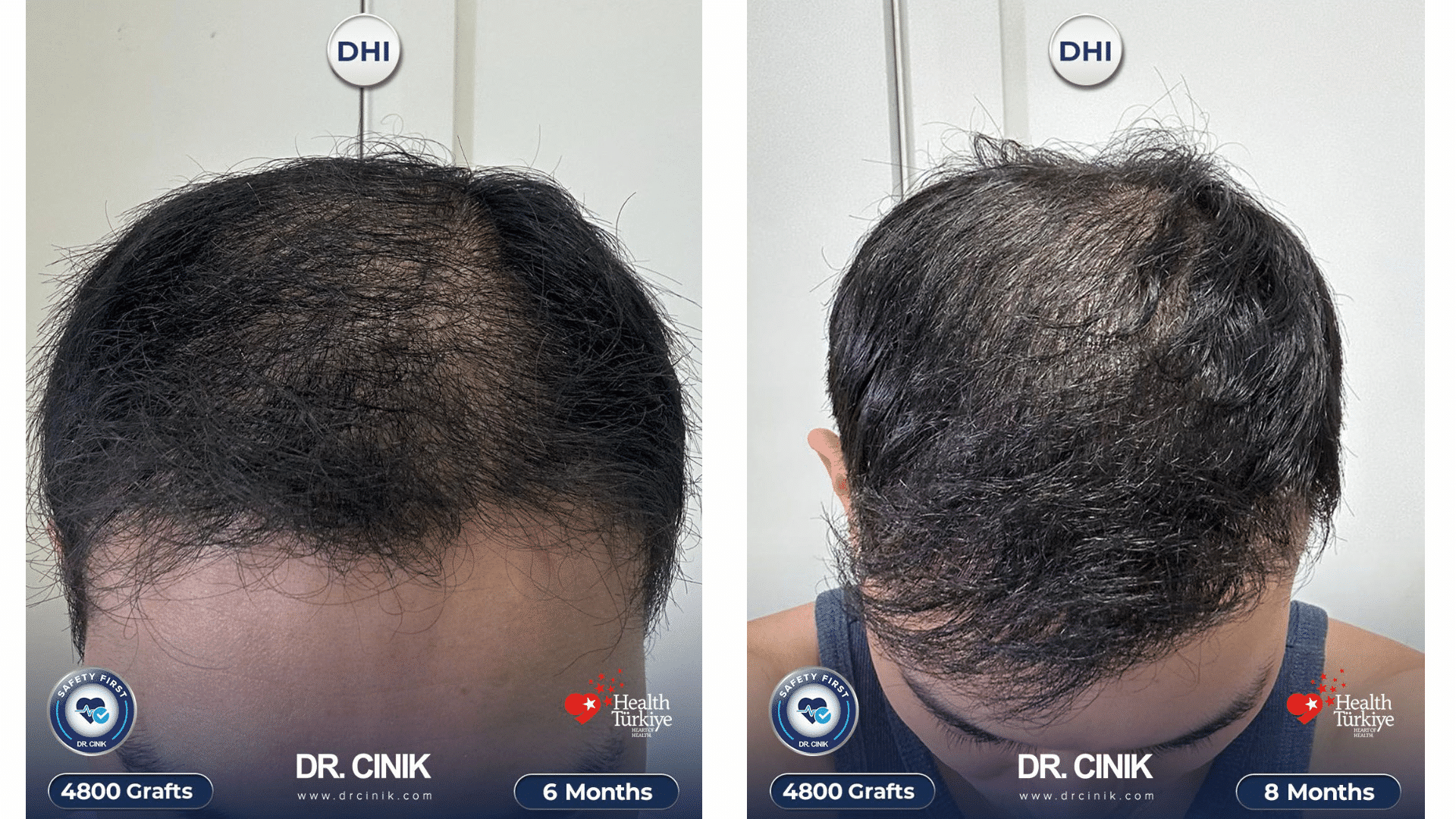 Résultat de la greffe de cheveux de Jillo, 4800 greffons, à 6 et 8 mois