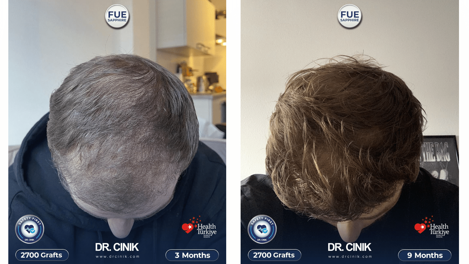 Greffe de cheveux de Larsee à 3 mois et 9 mois, saphir FUE, 2700 greffons