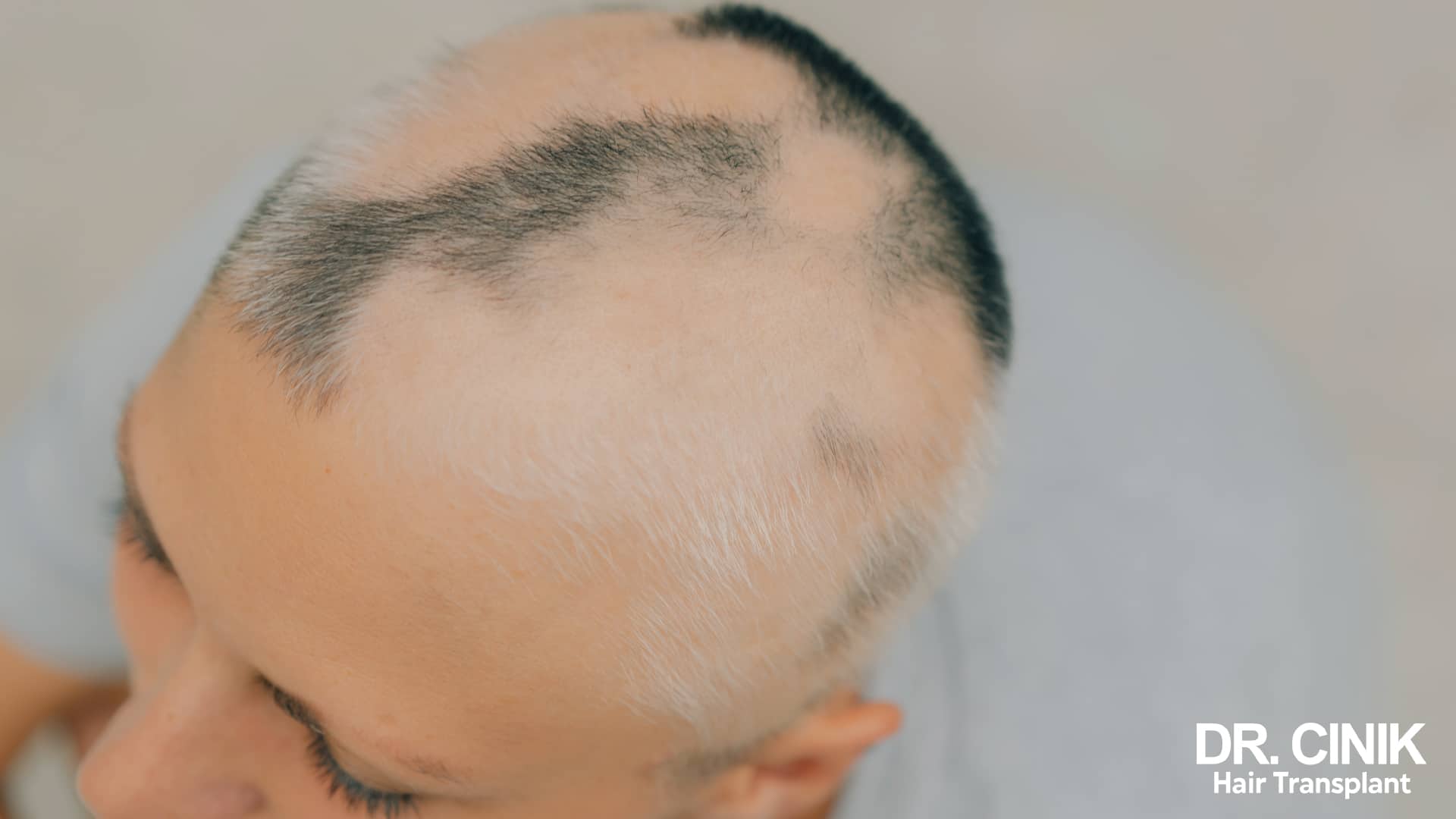 Alopecia areata is not ordinary baldness