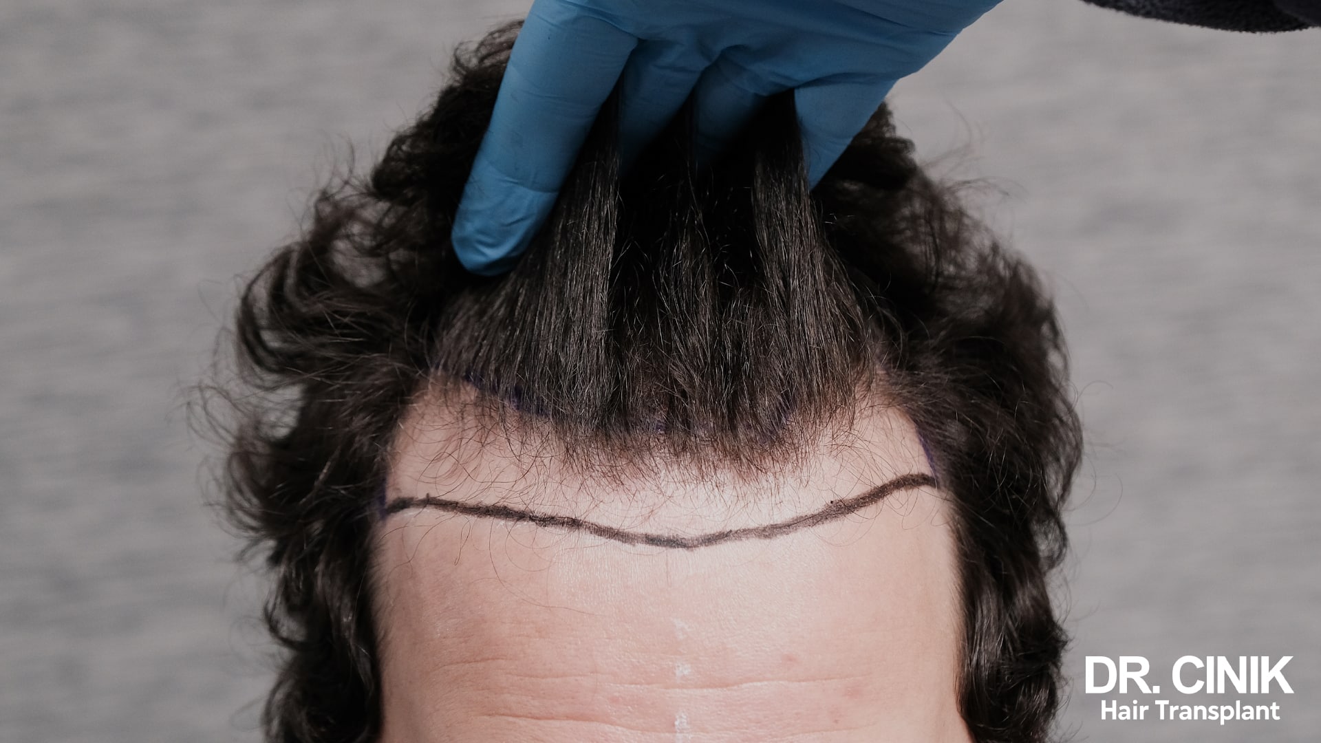 Why your hair type matters for a transplant