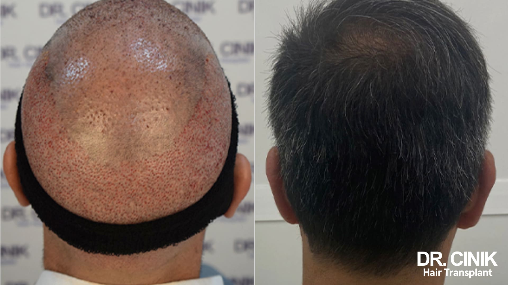 Diptych of the same patient seen from behind, on the left the freshly grafted scalp with its redness and crusts, on the right a dense, greying head of hair several months later