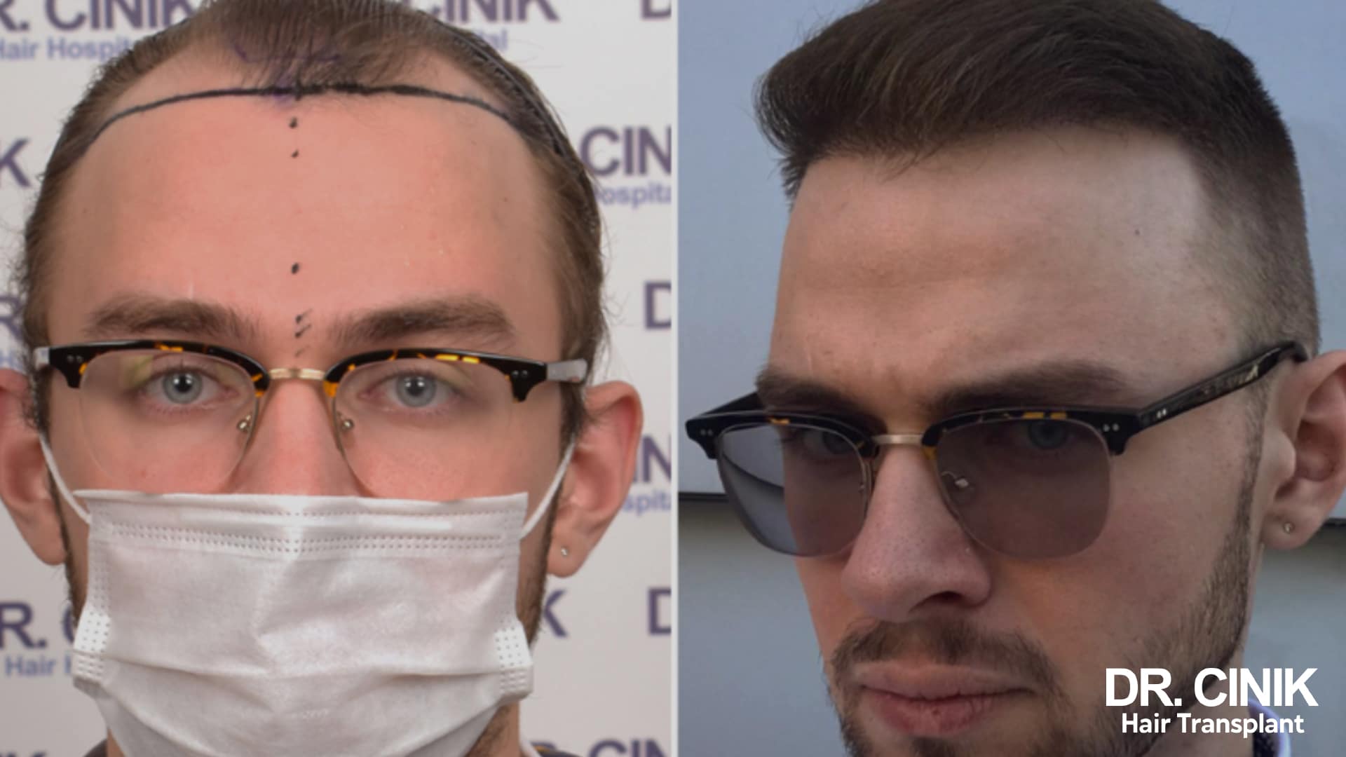 Before and after photo from the front of a patient wearing glasses, on the left the frontal line drawn in marker before surgery, on the right the regrown hair combed back