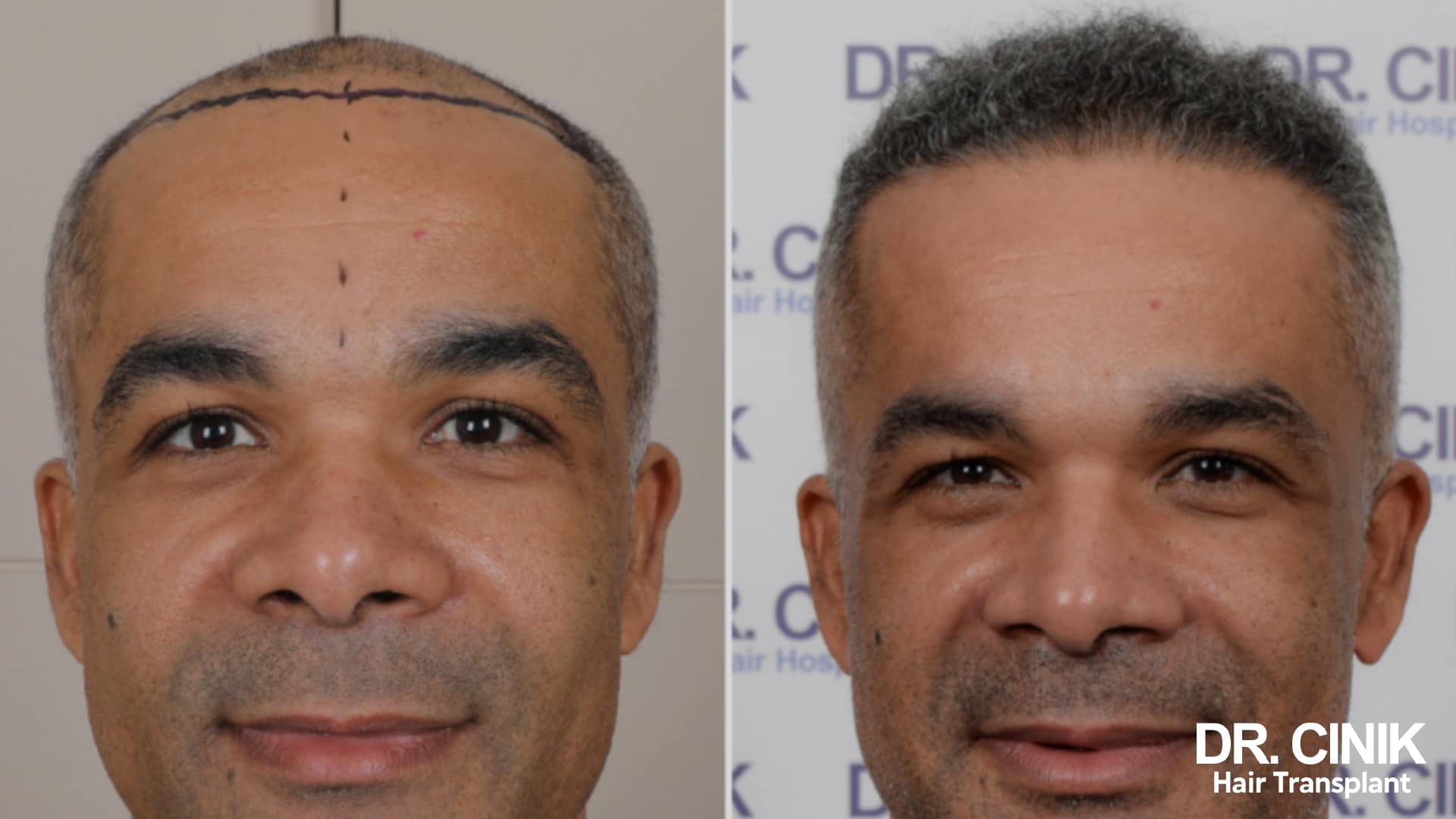Before and after photo from the front, on the left a largely bald head with the surgical marking of the frontal line, on the right dense hair across the whole scalp