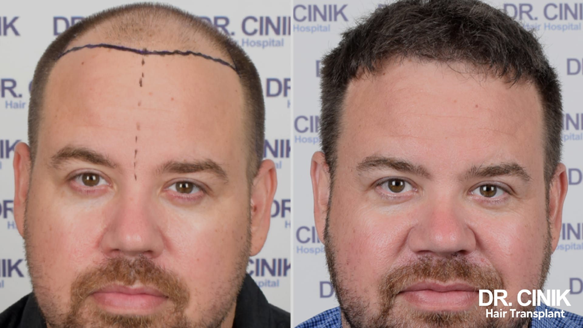 Before and after photo of a bearded patient, on the left the balding forehead with the marker guides drawn on, on the right the hair covering the frontal area