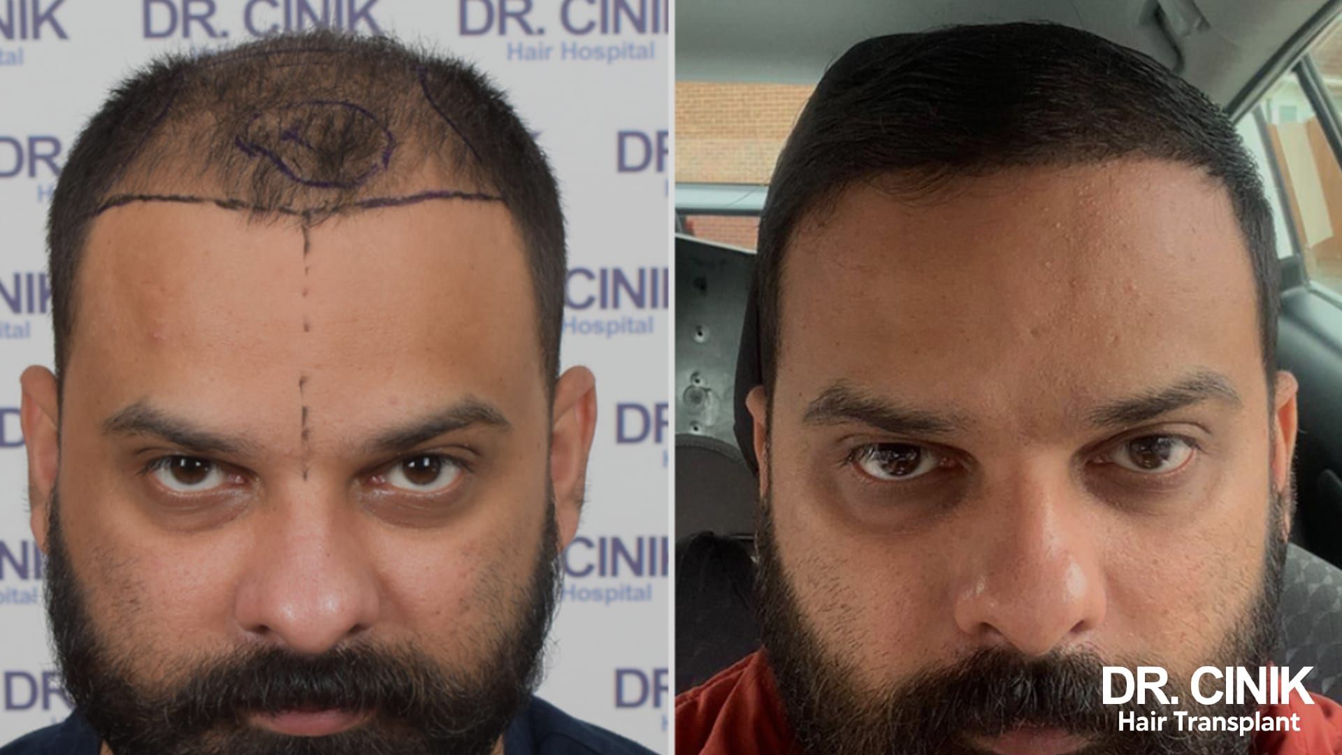 Masked surgeon in a white coat examining a patient's shaved head during a consultation
