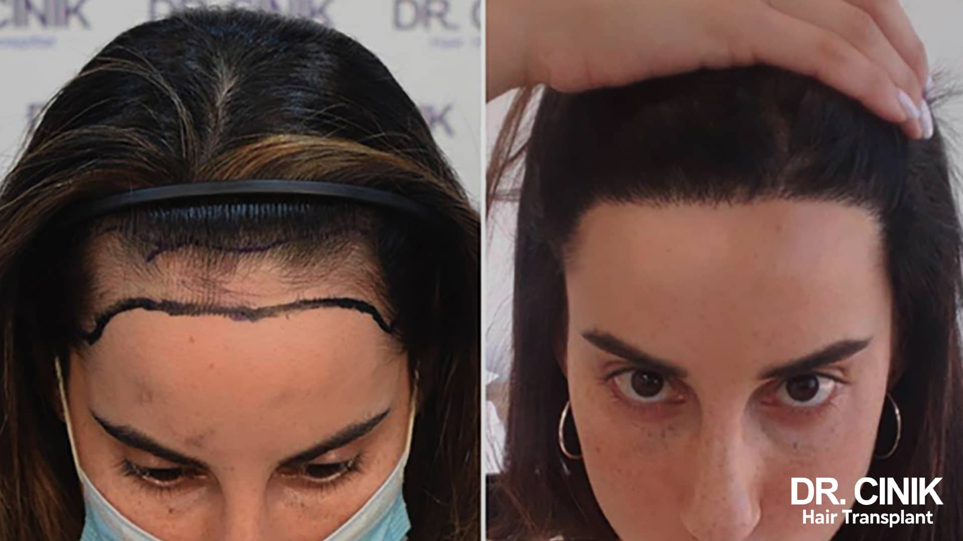 Before and after photo of a female patient, overhead view of the top of the head, on the left the widened parting with the implantation line drawn on, on the right dense hair across the whole area