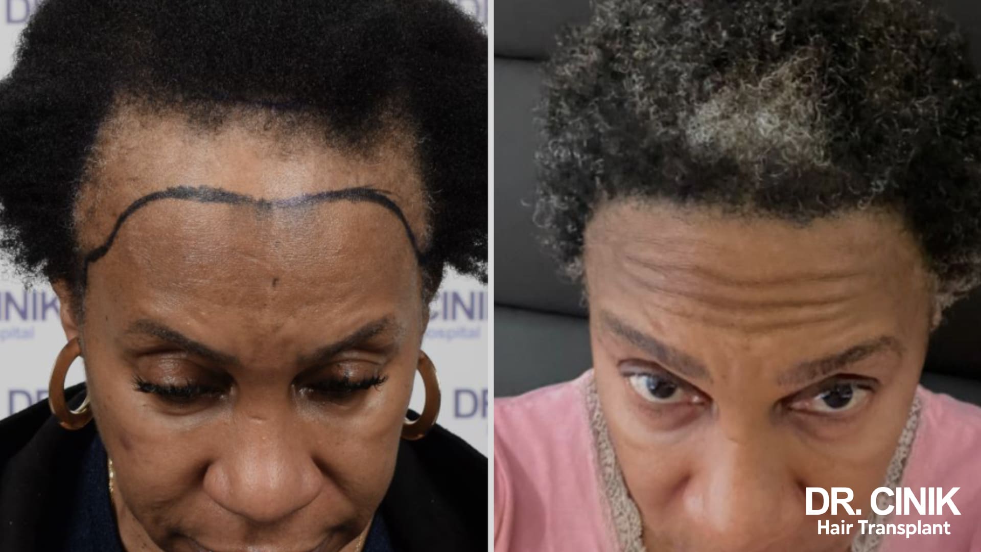 Before and after photo of a female patient with afro-textured hair, on the left the receding frontal line marked with a drawn stroke, on the right the hair covering the treated area
