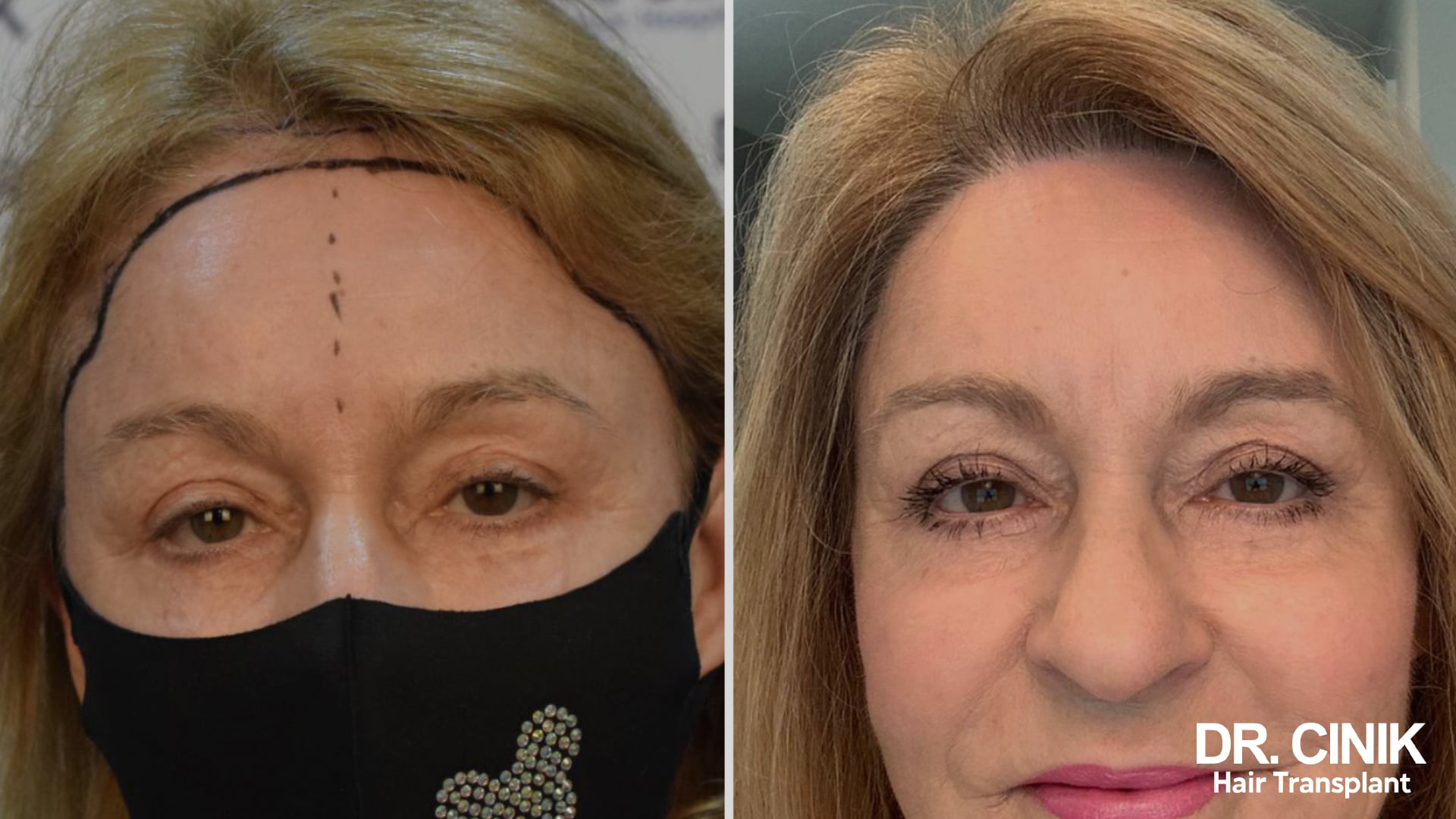 Before and after photo of a blonde female patient, on the left the frontal line drawn on a thinning scalp, on the right thick hair across the forehead