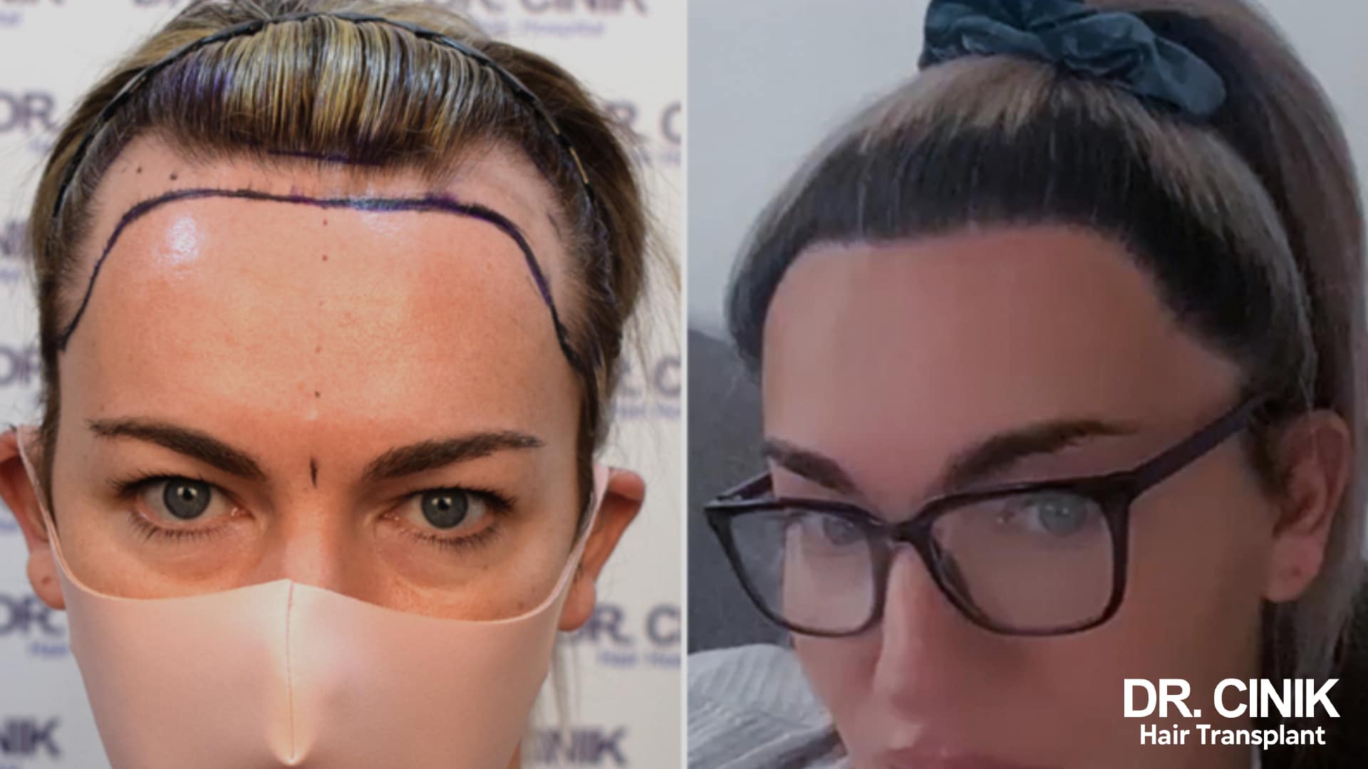 Before and after photo of a female patient with a high forehead, on the left the marker drawing of the future lowered frontal line, on the right the regrown fringe closing the forehead back up