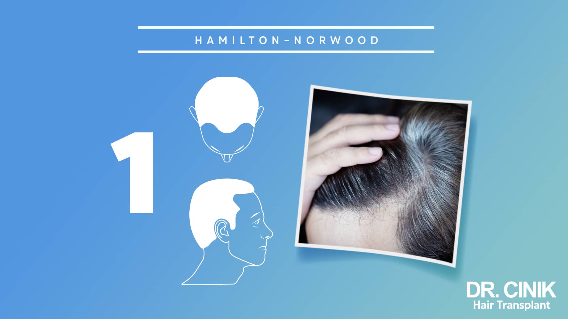 Hamilton-Norwood board for stage 1, with front and side diagrams of a full head of hair beside a photograph of a scalp parted by hand showing no recession