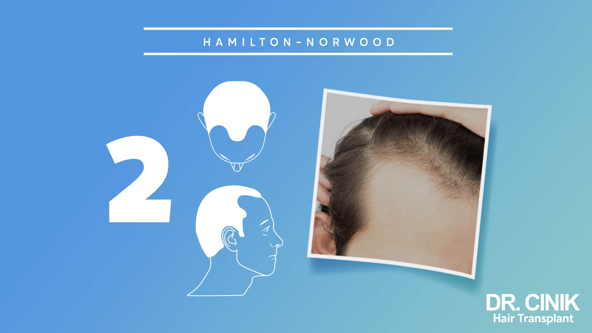 Hamilton-Norwood board for stage 2, with front and side diagrams of a light symmetrical recession at the temples beside a photograph of a receded frontal hairline