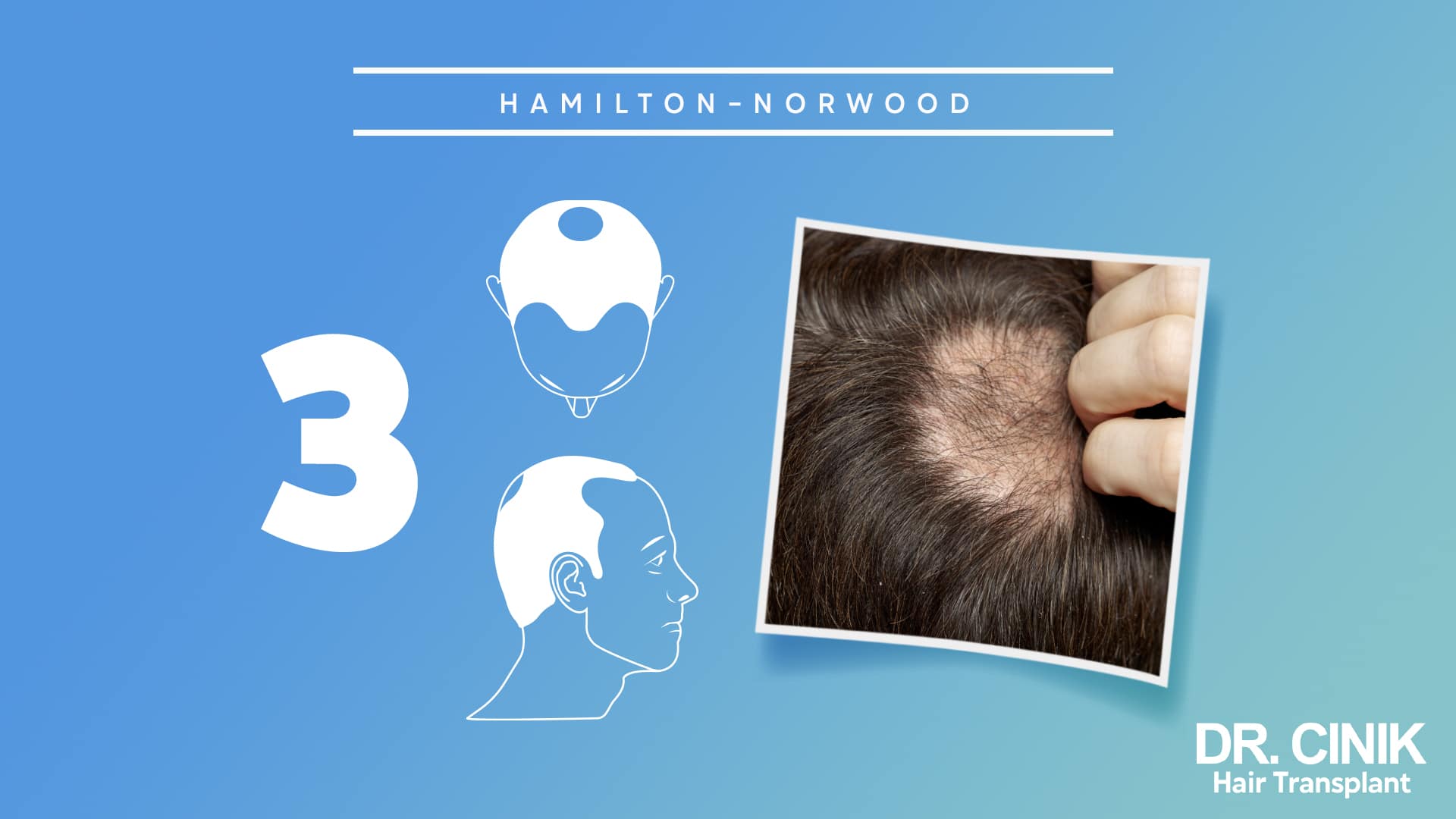 Hamilton-Norwood board for stage 3, with front and side diagrams of deeply hollowed temples beside a photograph of a scalp held open at the front