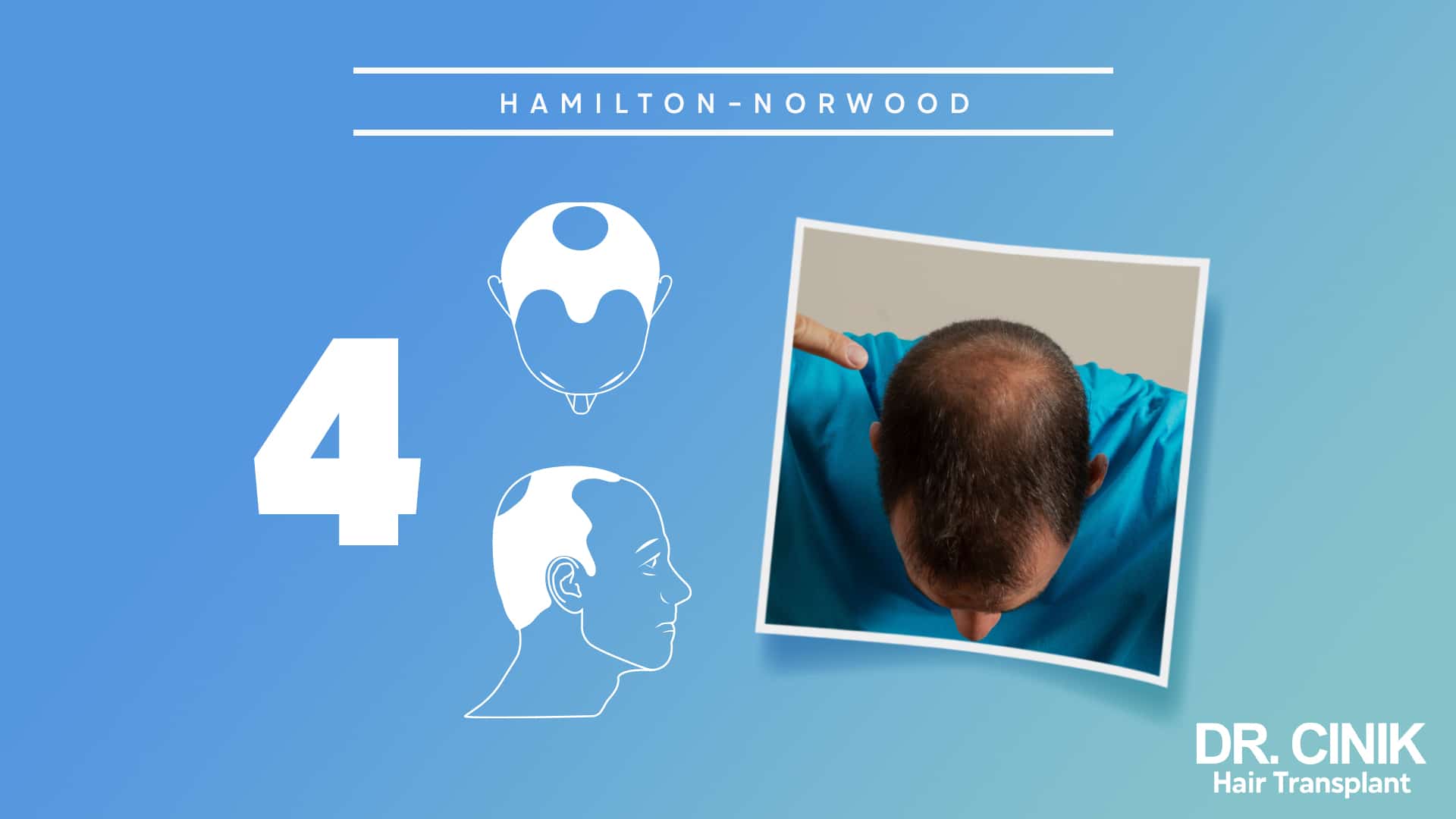 Hamilton-Norwood board for stage 4, with front and side diagrams of a bald crown separated from the forehead by a band of hair beside a photograph of a man bending his head forward