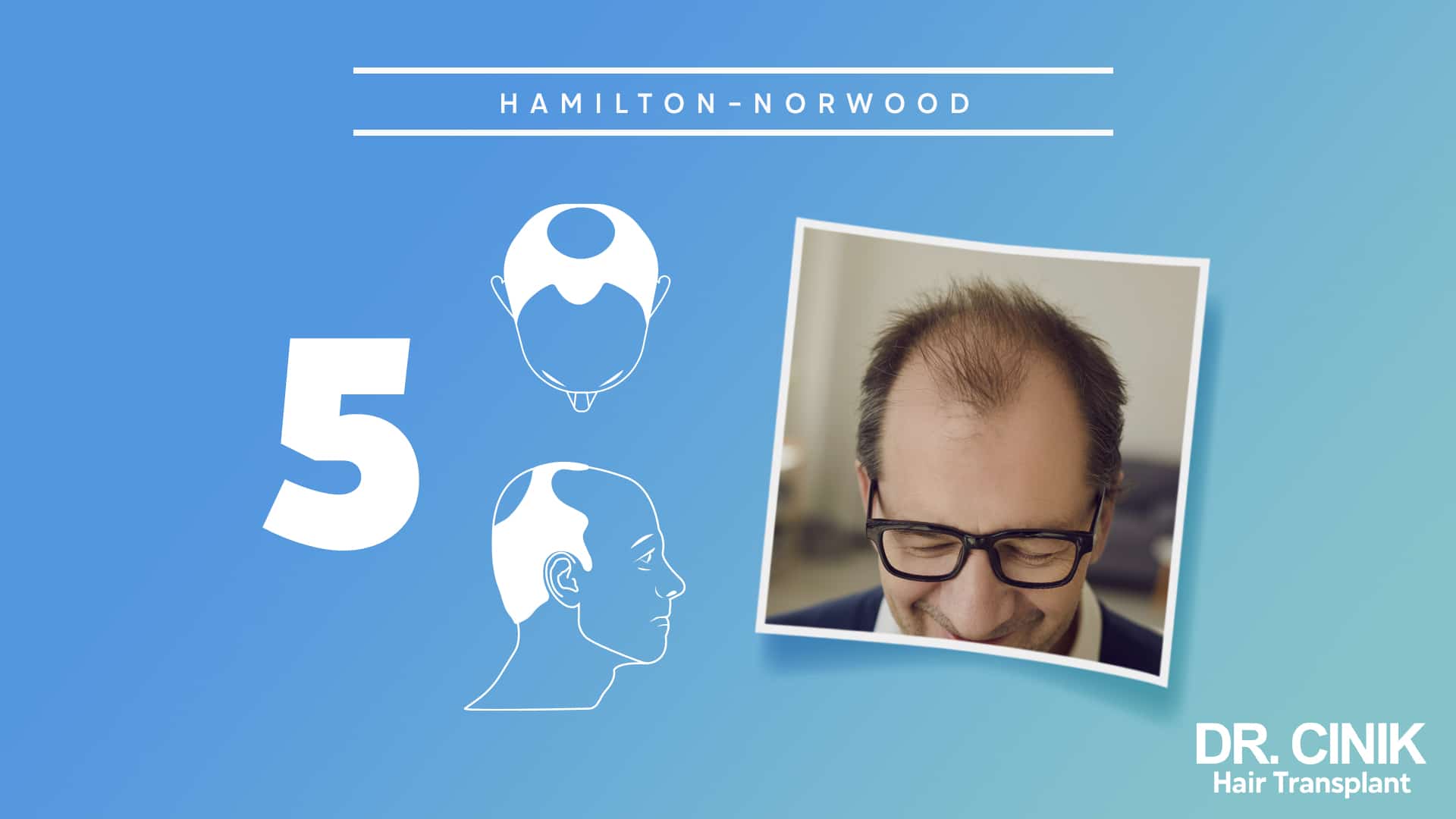 Hamilton-Norwood board for stage 5, with front and side diagrams of a thinned central band between the two bald zones beside a photograph of a man with a sparse crown