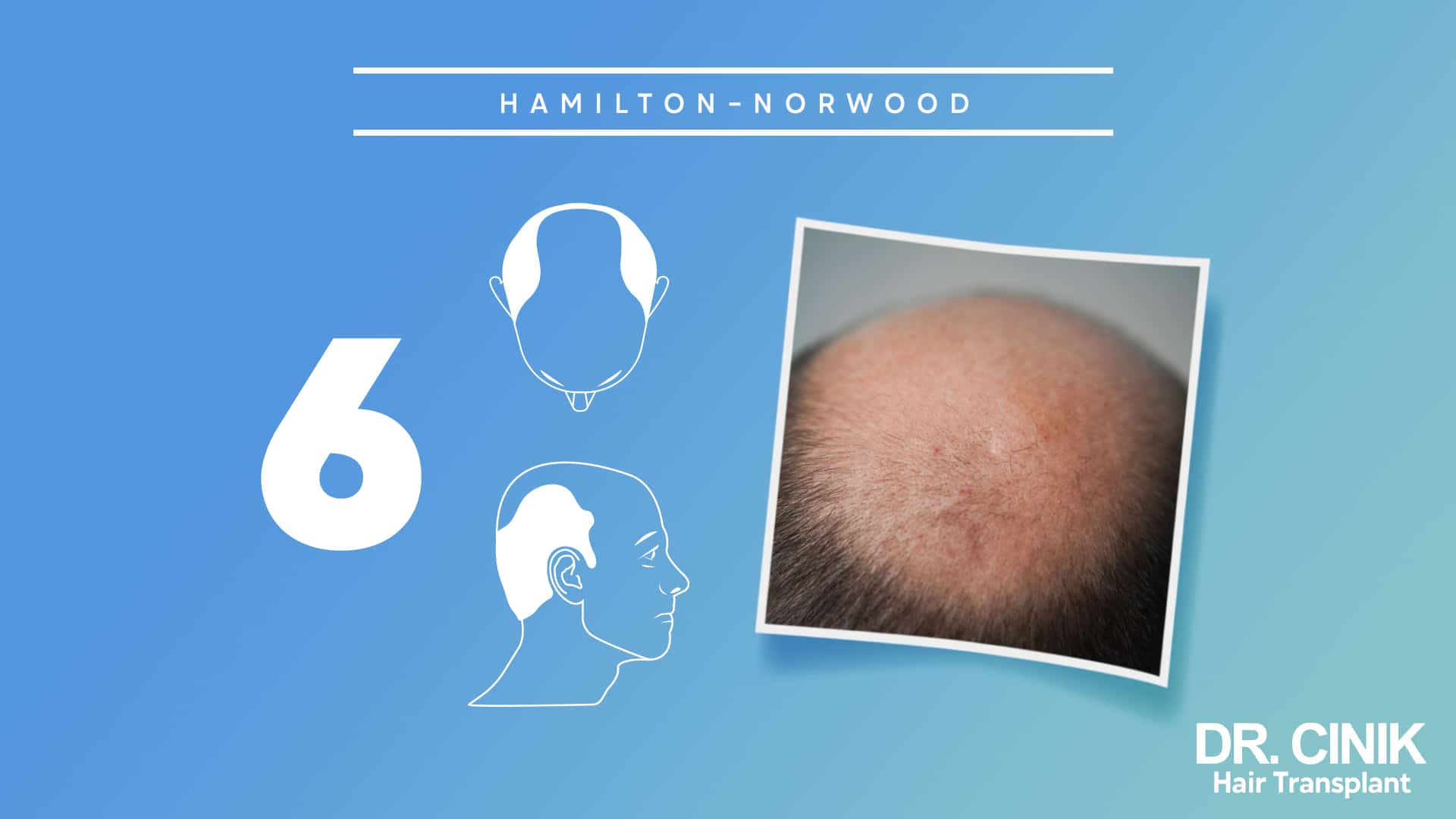 Hamilton-Norwood board for stage 6, with front and side diagrams of the forehead and crown merged into one bald surface beside a close photograph of a bald scalp
