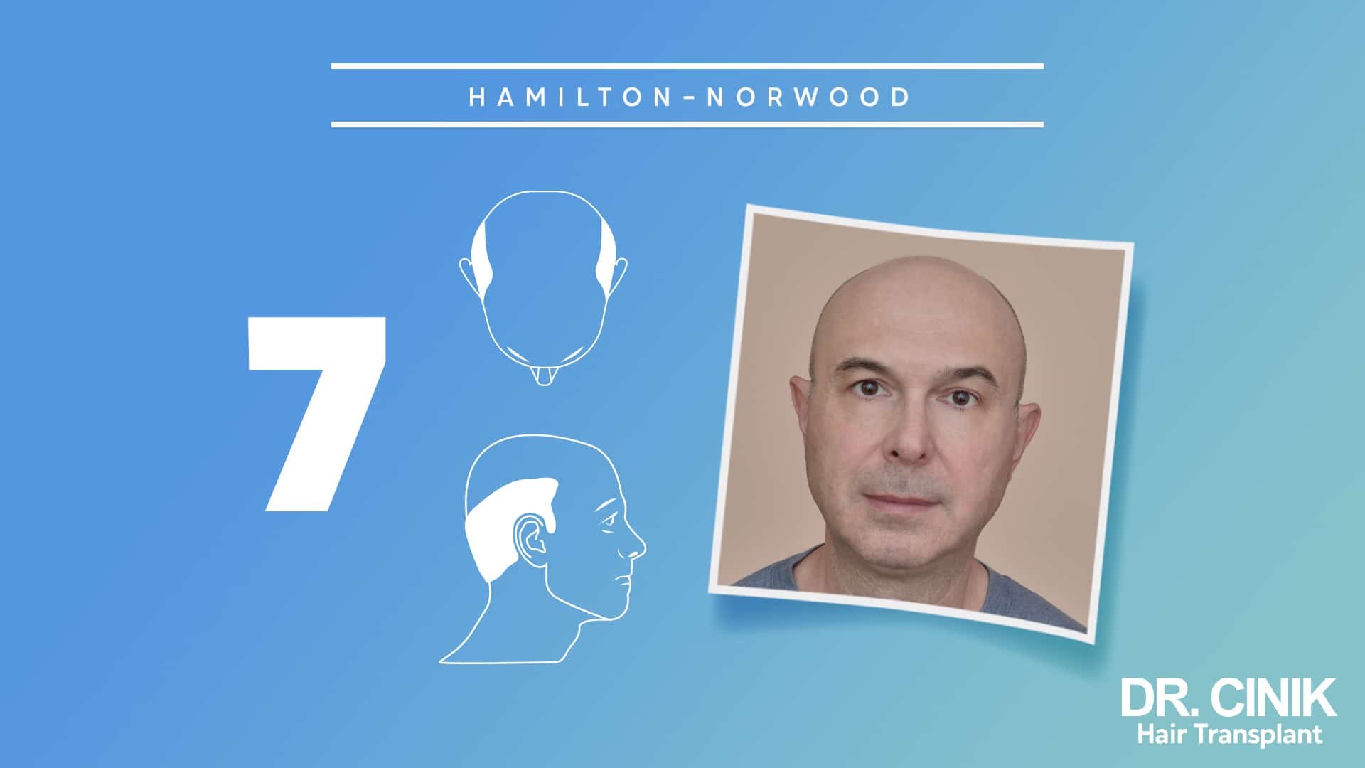 Hamilton-Norwood board for stage 7, with front and side diagrams of a narrow crown of hair from ear to ear beside a portrait of a man with a fully bald scalp