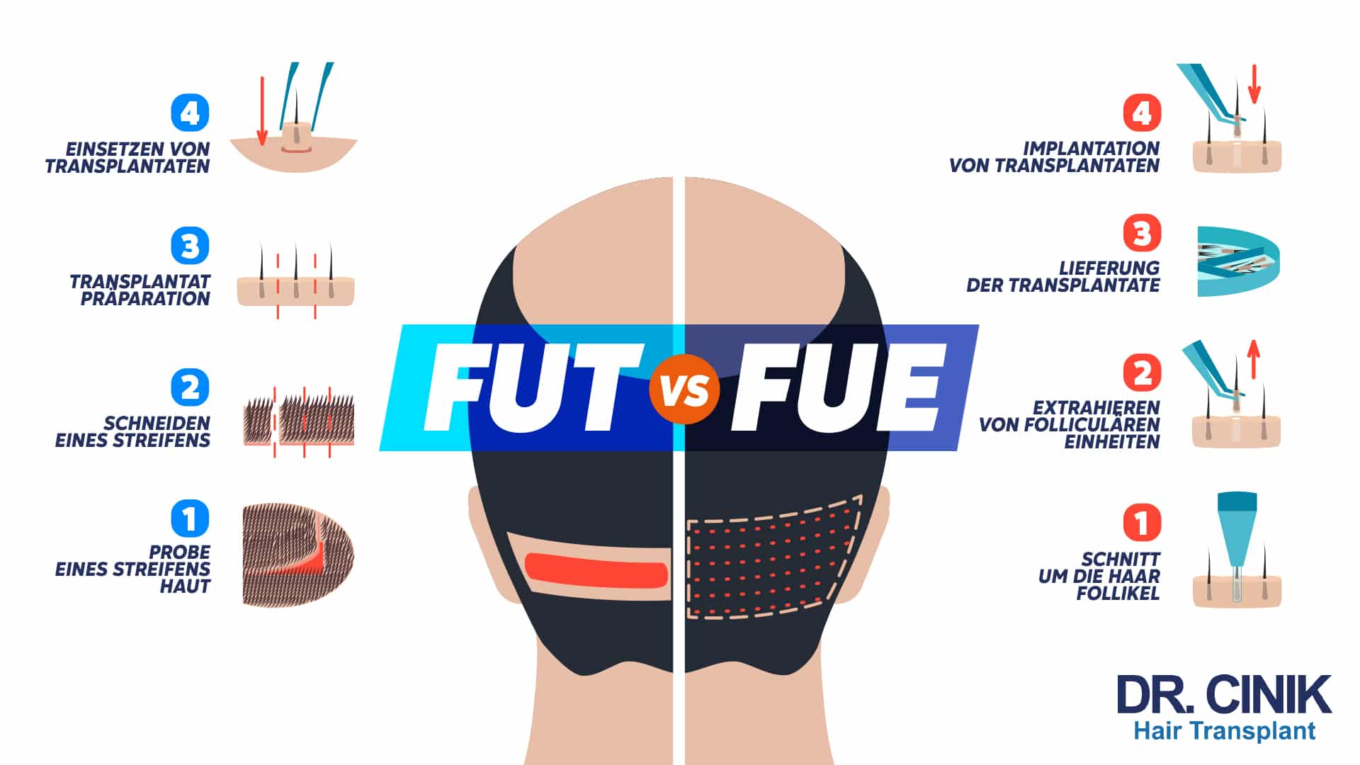 Infografik FUT vs FUE über einem Hinterkopf, links in Blau die vier Schritte der FUT, Probe eines Streifens Haut, Schneiden eines Streifens, Transplantat Präparation und Einsetzen von Transplantaten, rechts in Rot die vier Schritte der FUE, Schnitt um die Haarfollikel, Extrahieren von follikulären Einheiten, Lieferung der Transplantate und Implantation von Transplantaten