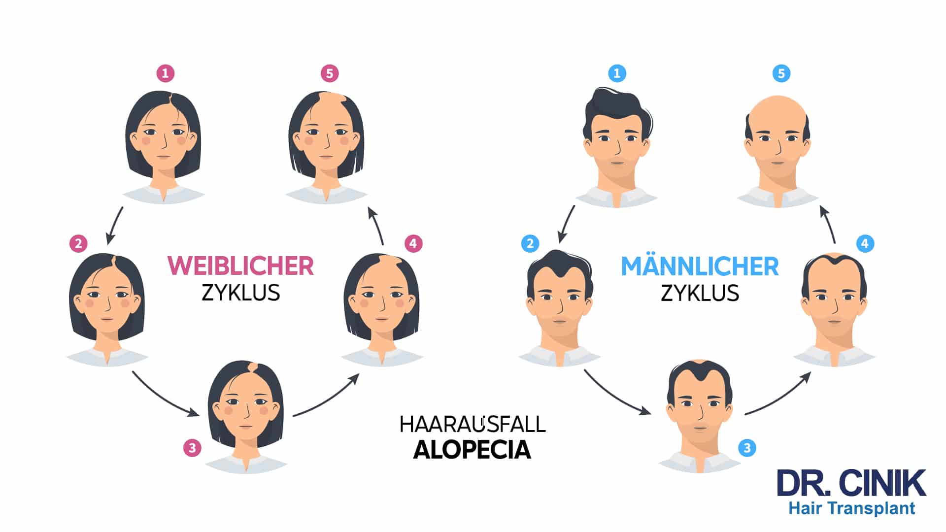 Grafik mit dem weiblichen und dem männlichen Zyklus im Vergleich, jeweils fünf nummerierte Stadien rund um die Aufschrift Haarausfall Alopecia