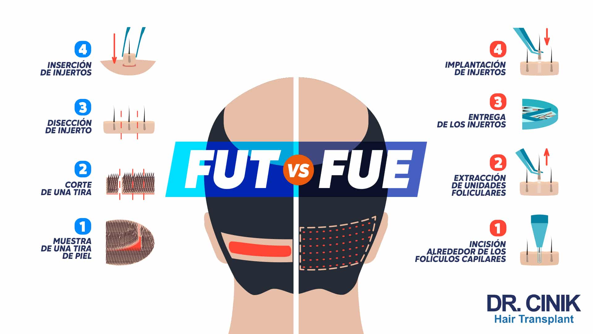 Infografía que enfrenta las cuatro etapas de la FUT, de la muestra de una tira de piel a la inserción de los injertos, con las cuatro etapas de la FUE, de la incisión alrededor de los folículos capilares a la implantación de los injertos